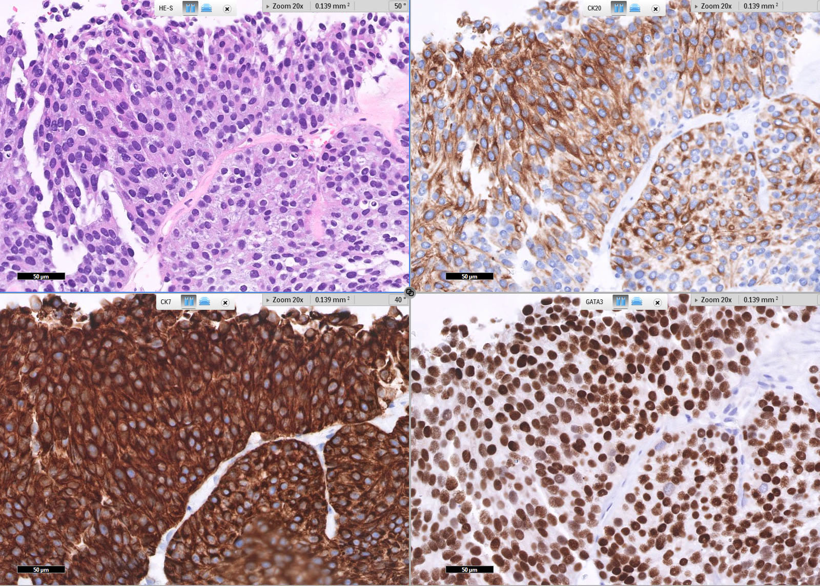 urothelial carcinoma prostate pathology outlines