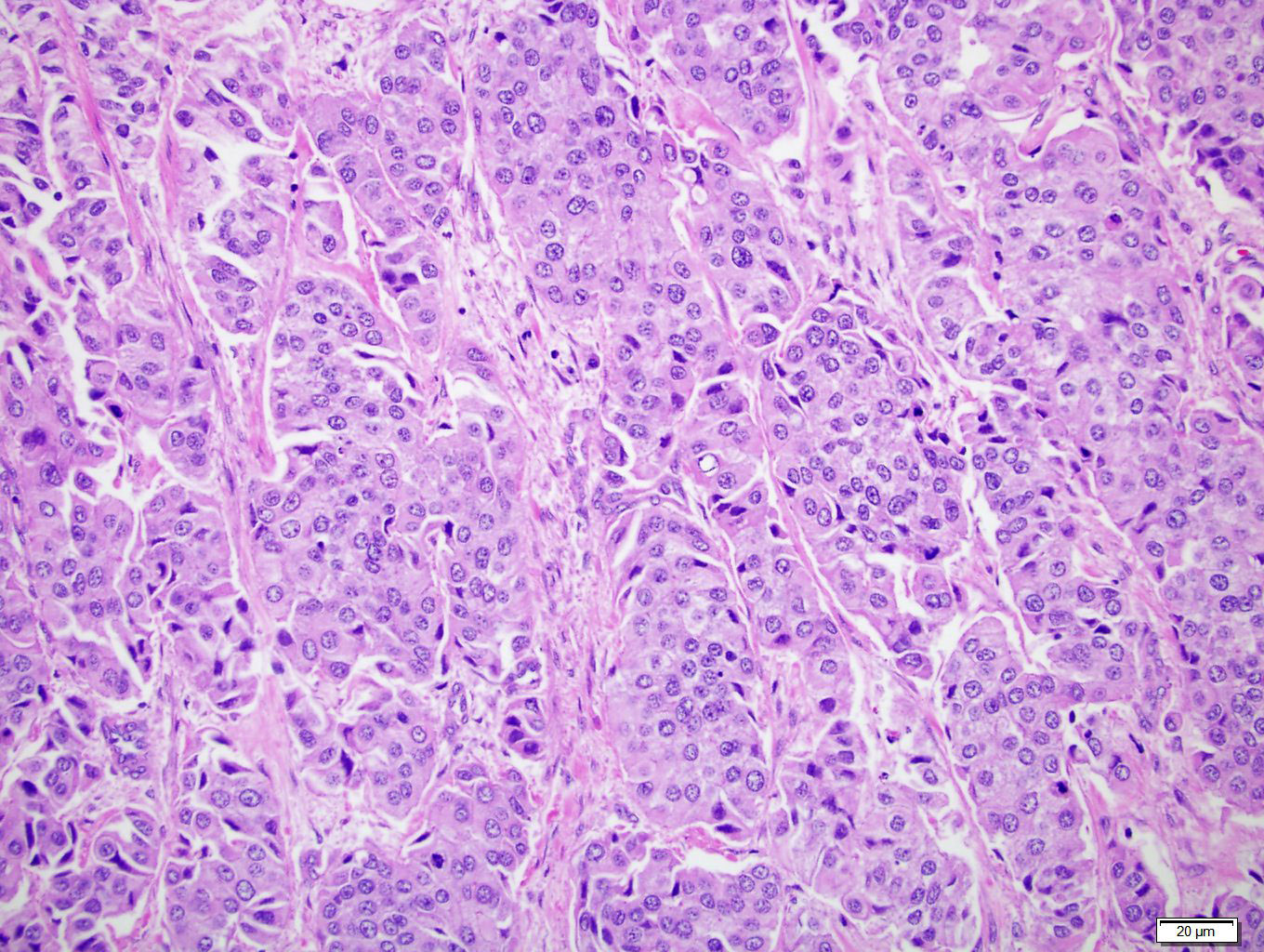 urothelial carcinoma prostate pathology outlines