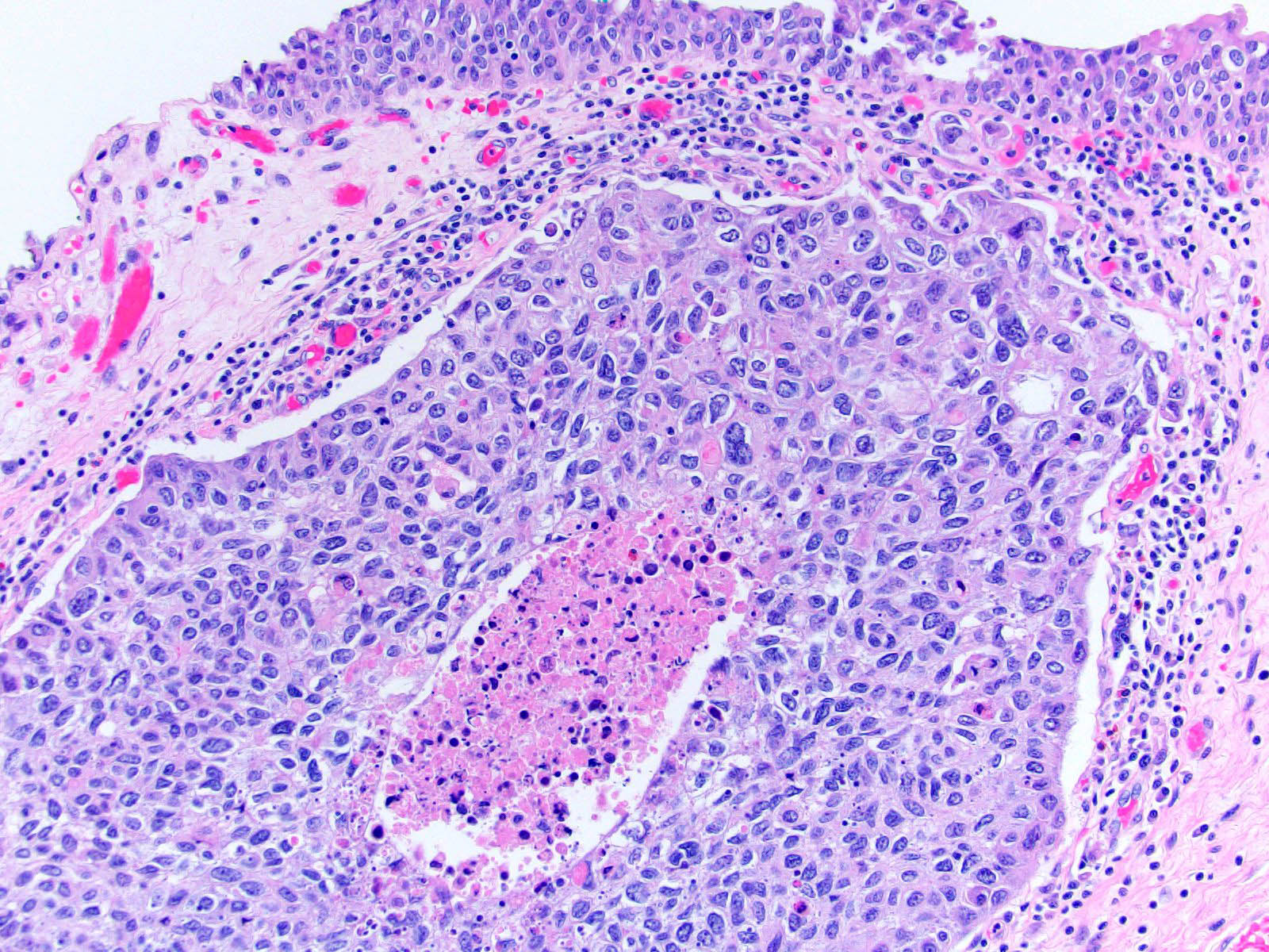 Invasive urothelial carcinoma with comedo necrosis