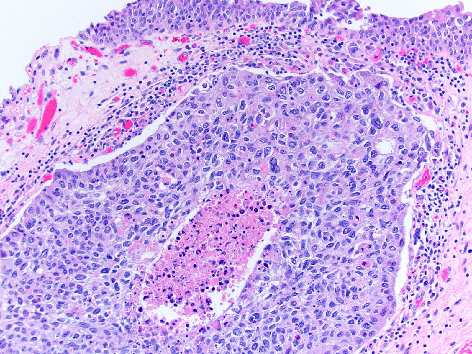 urothelial carcinoma prostate pathology outlines)