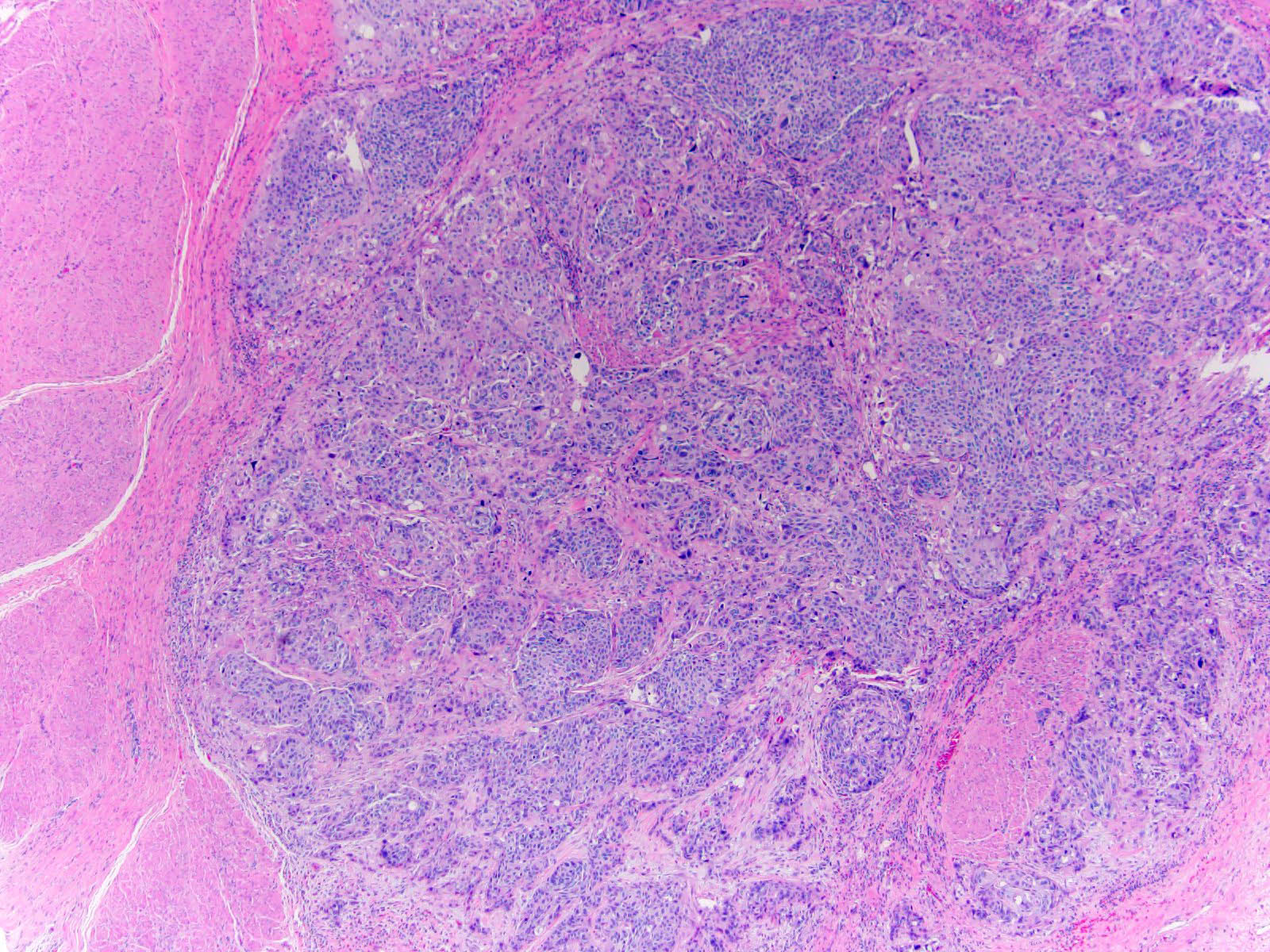 prostatit copchik prostatitis izomgörcsök