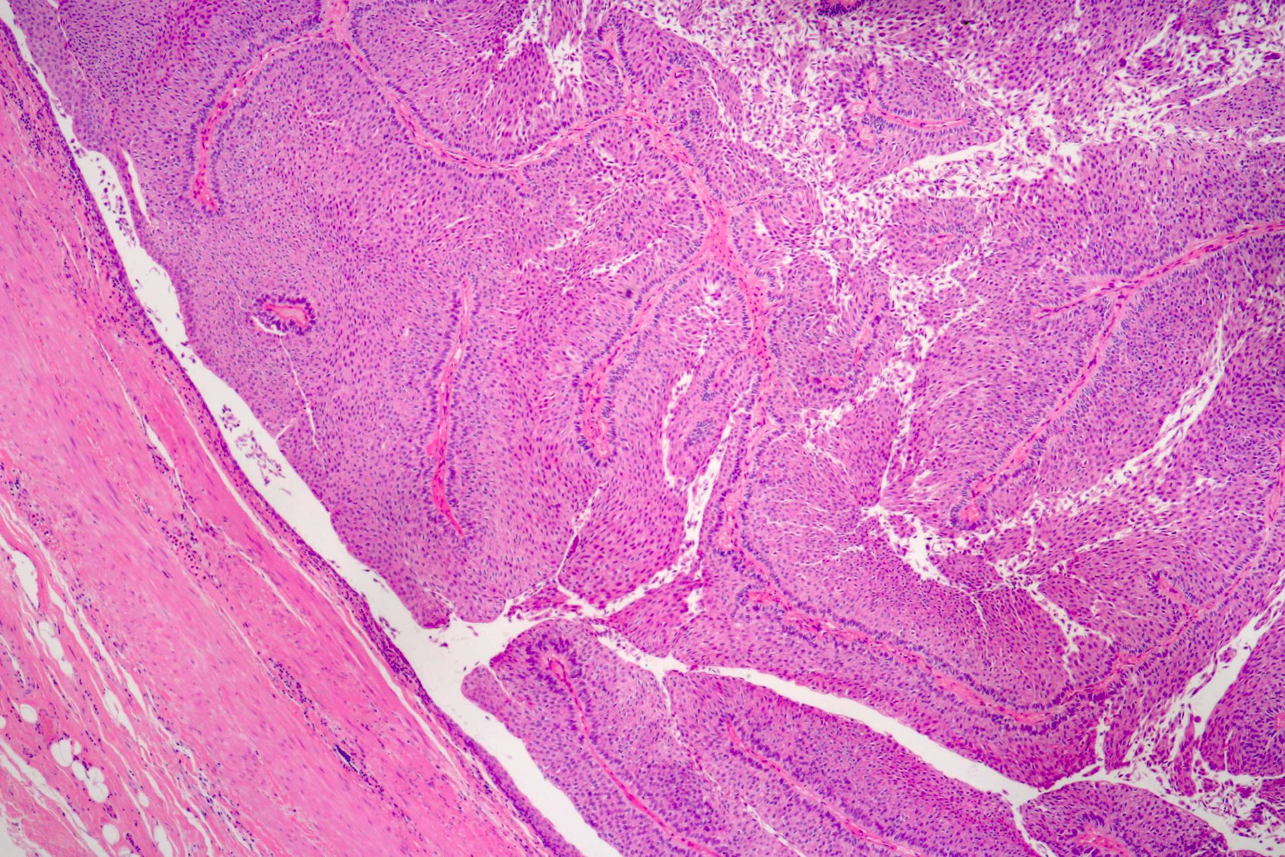 Exophytic intraluminal urothelial papillary neoplasm