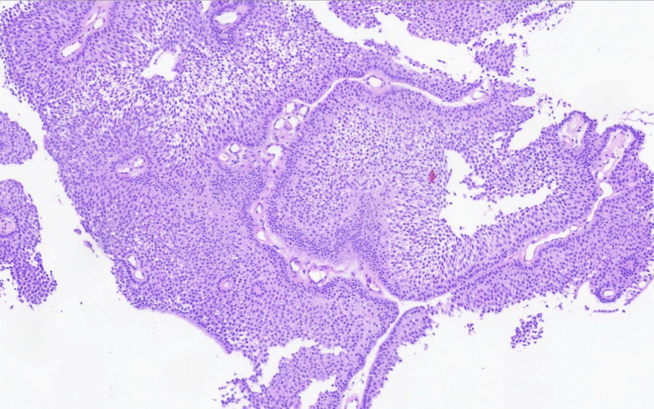 Hypercellular monotonous urothelial lining