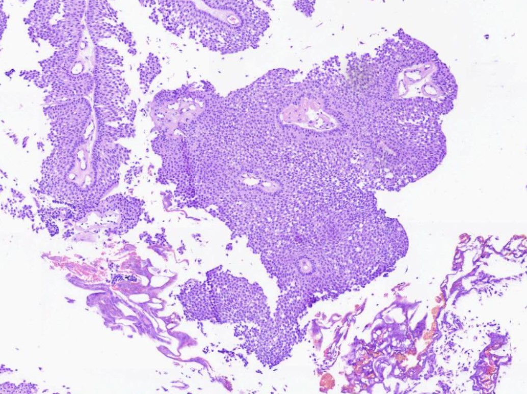 Hypercellular monotonous urothelial lining
