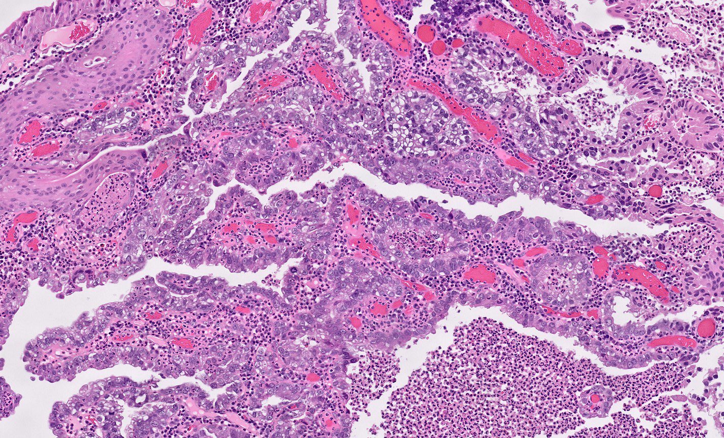 Clear cell (adeno)carcinoma