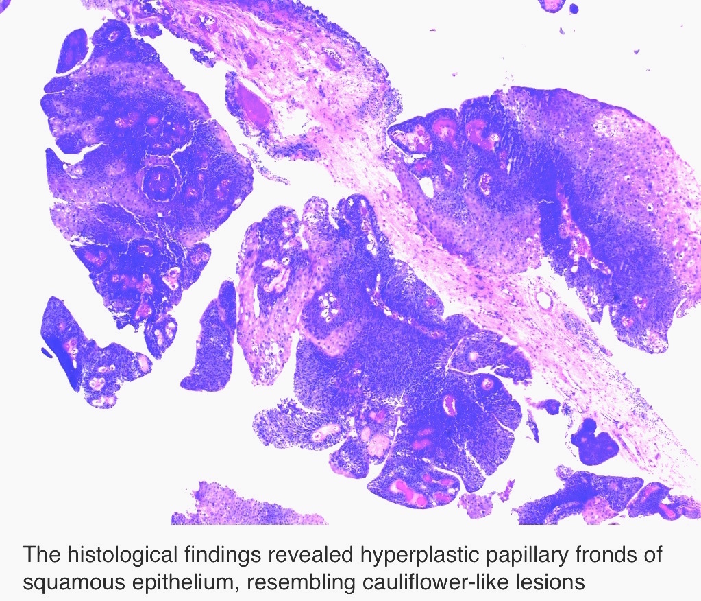 condyloma acuminatum vulva pathology outlines
