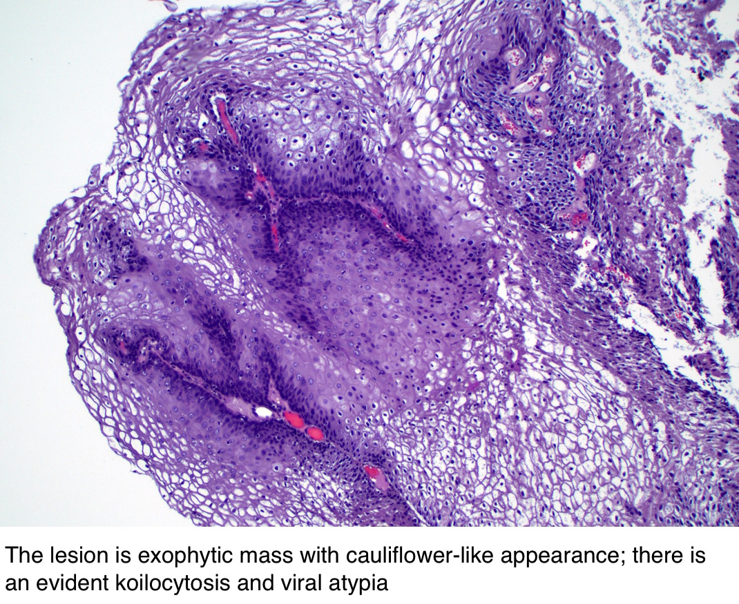 condyloma acuminatum vulva pathology outlines)