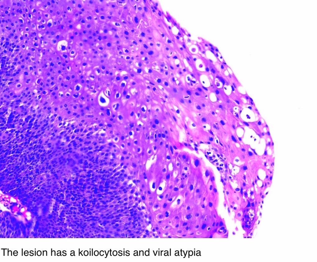 condyloma acuminatum vulva patológia körvonalazódik a genitális szemölcsök egy szemölcs