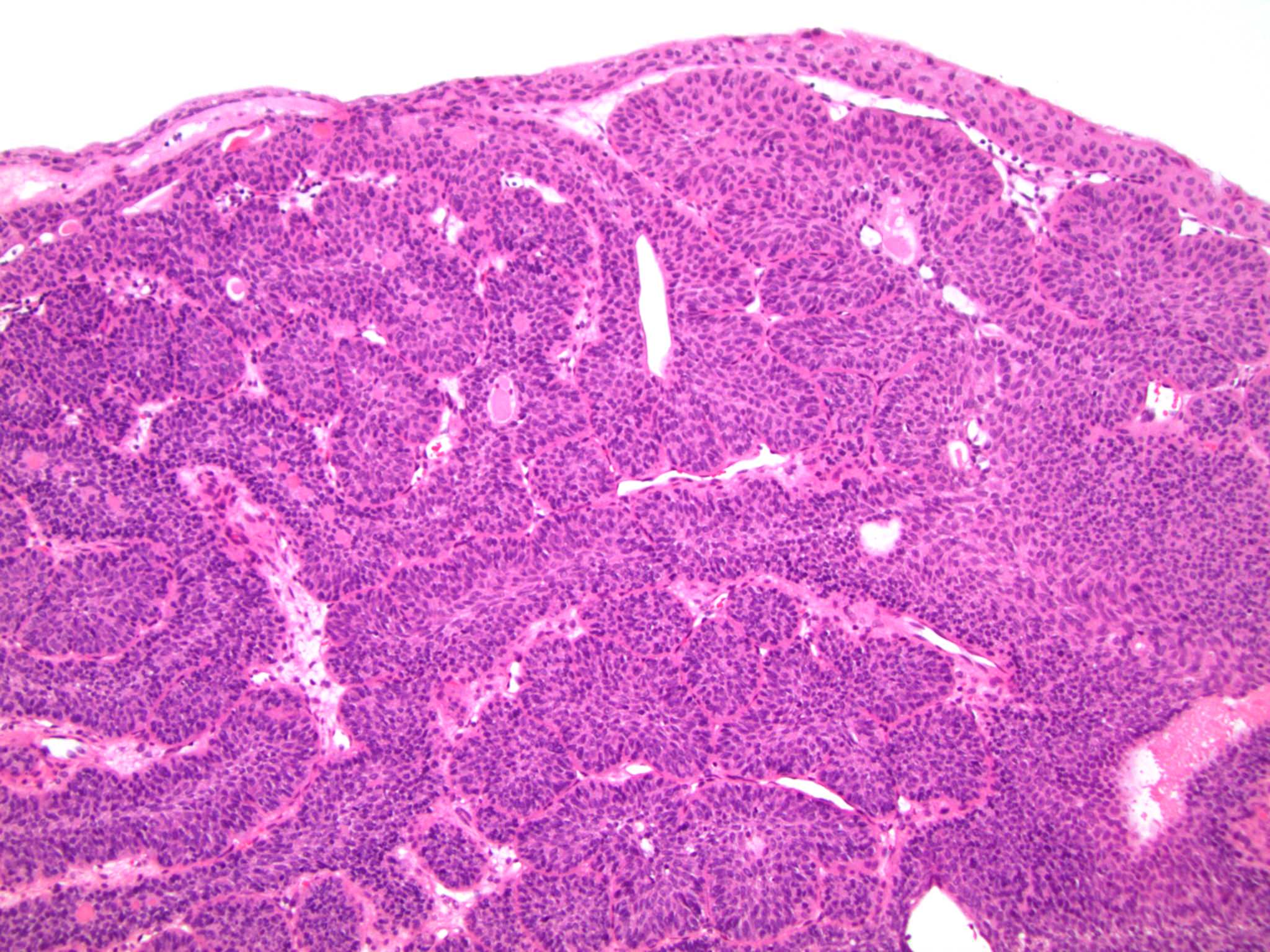 inverted papilloma bladder pathology outlines