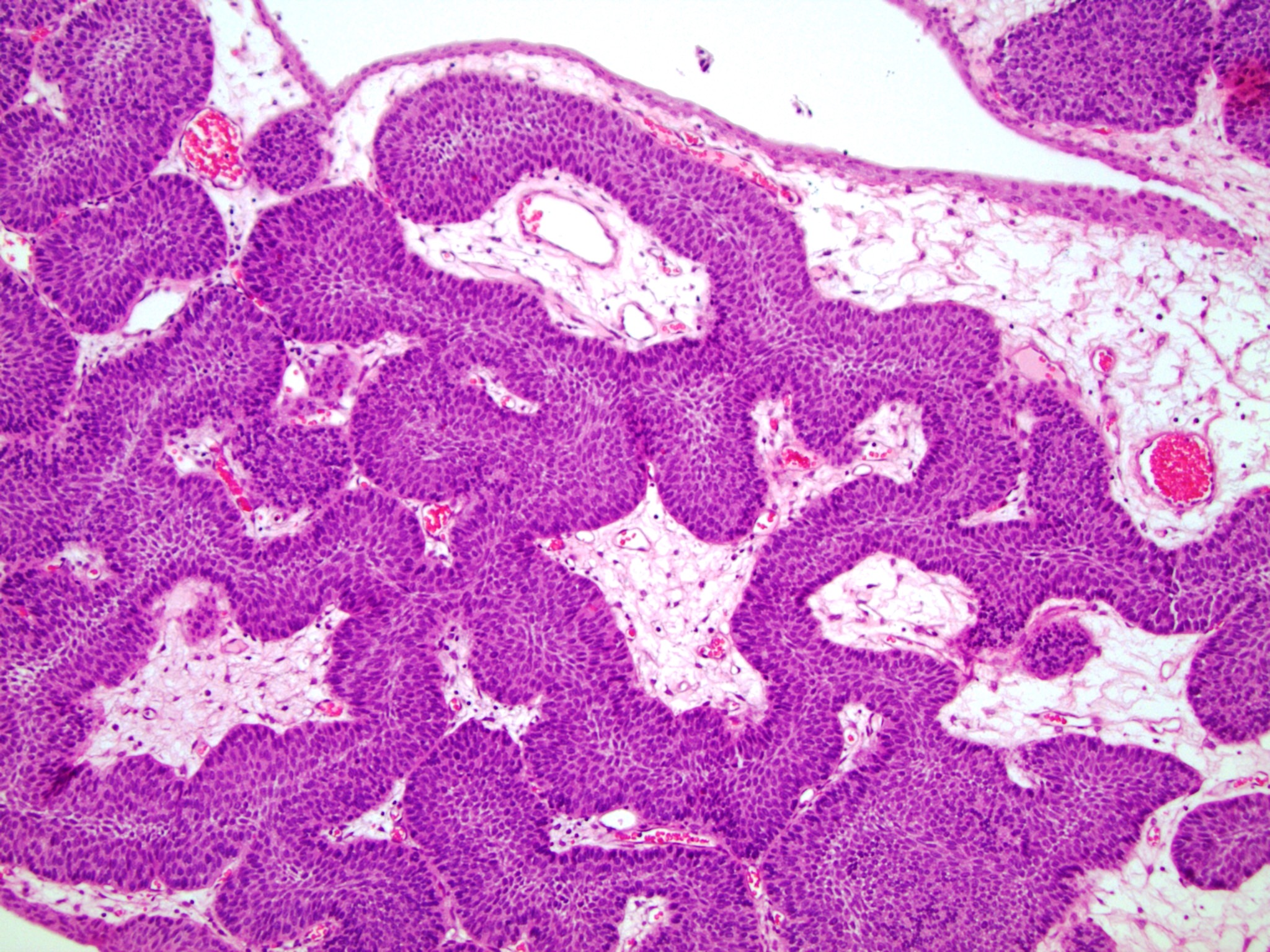 Inverted urothelial papilloma pathology, Urinary bladder inverted papilloma
