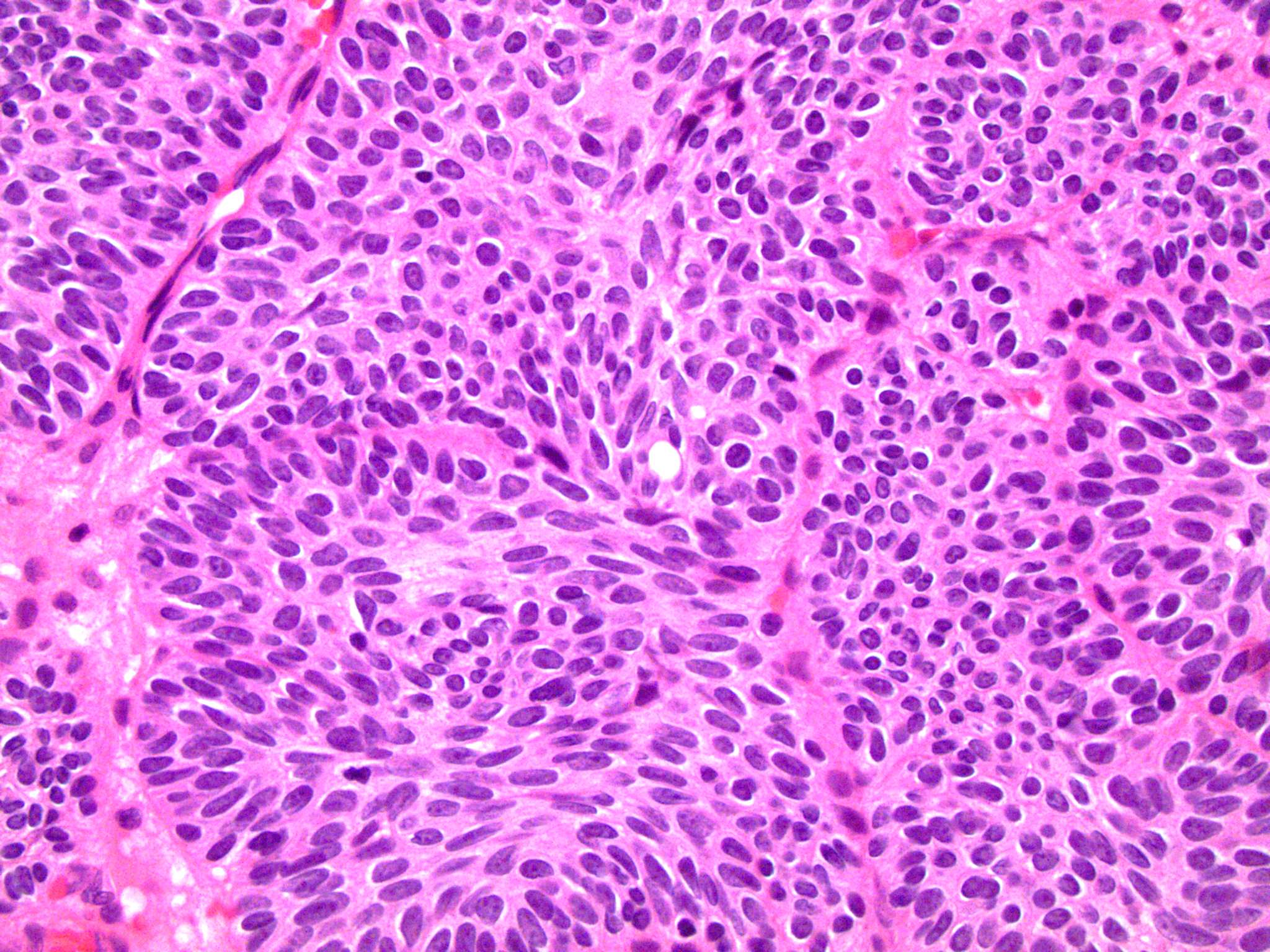 inverted papilloma urothelial