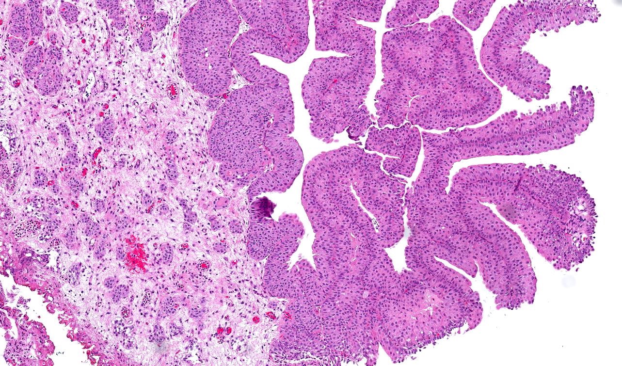 Nested urothelial carcinoma
