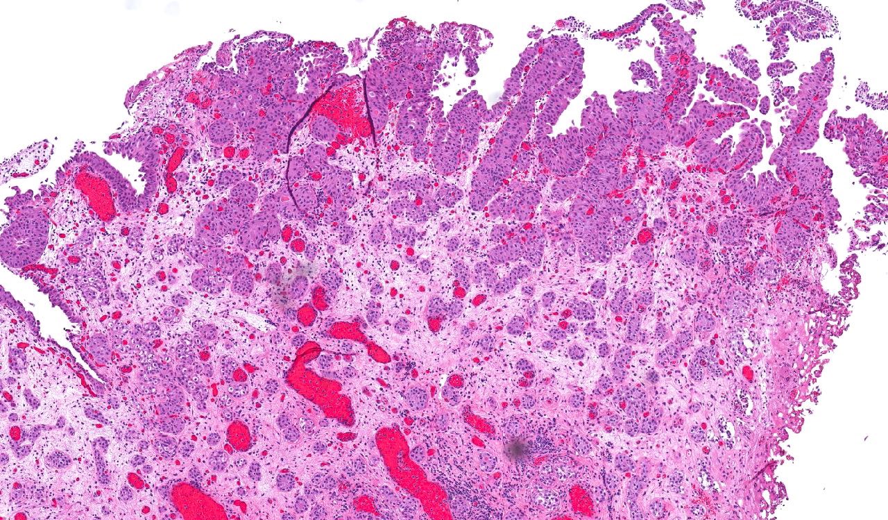 Nested urothelial carcinoma