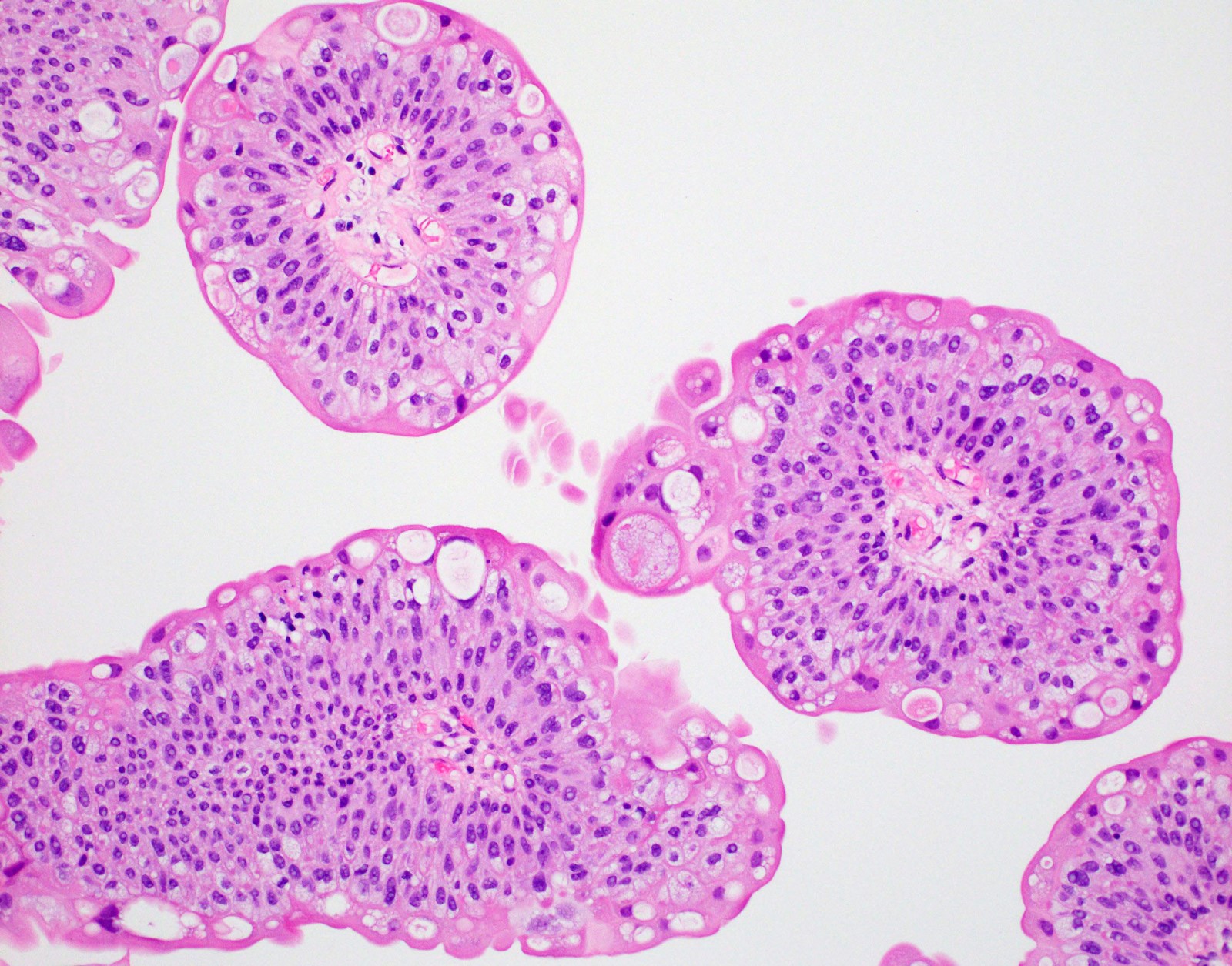 Bladder papilloma pathology