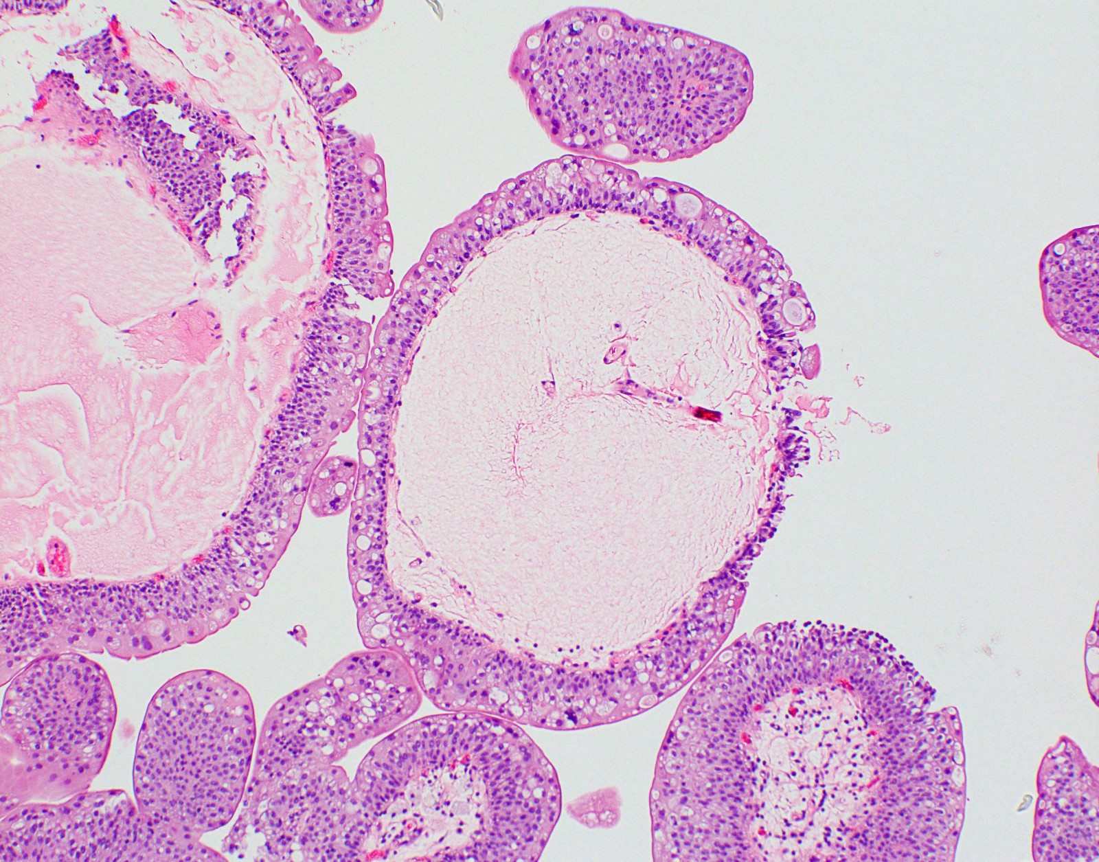 Urethral papilloma pathology outlines