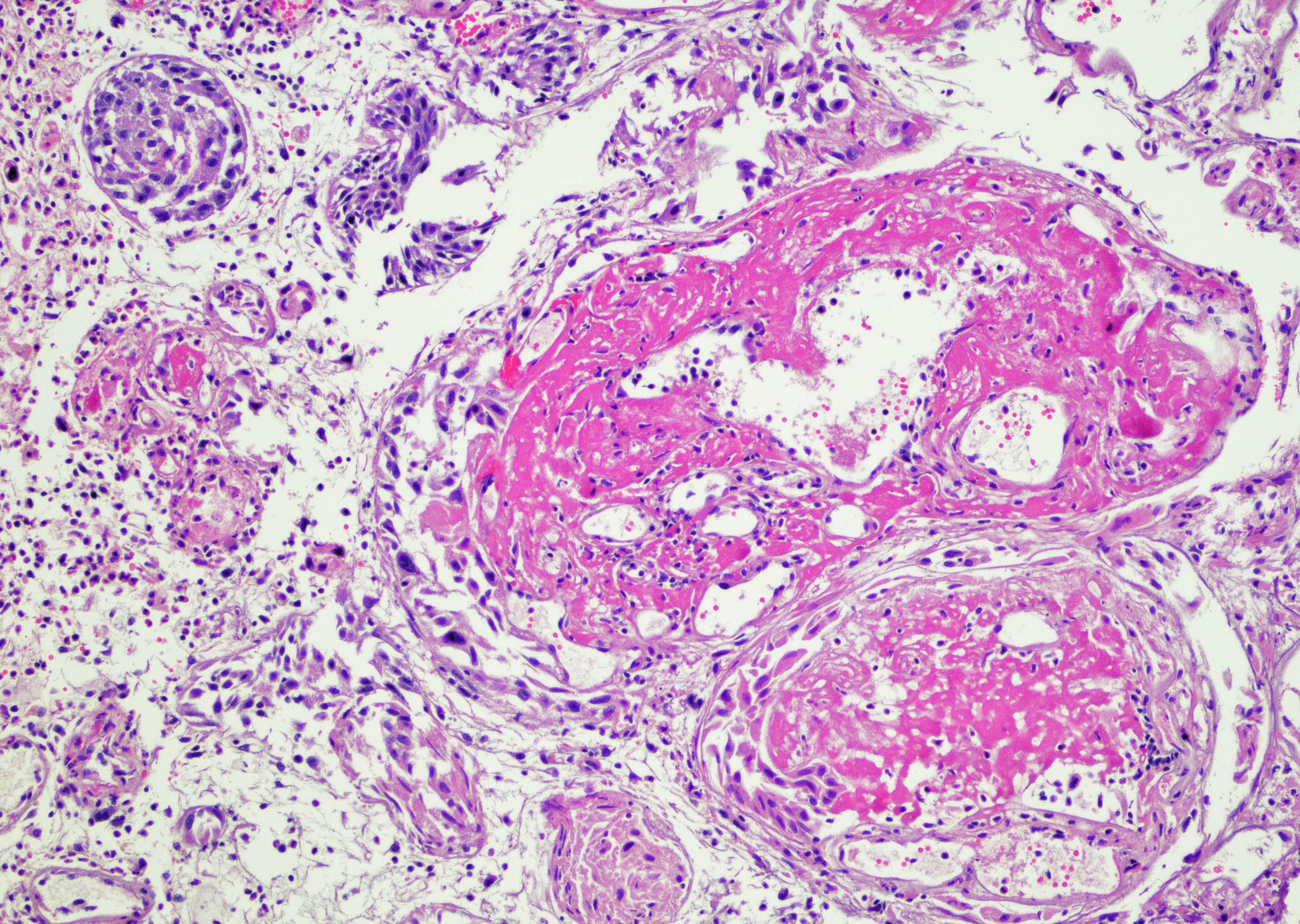 Urothelial cells enclosing fibrin