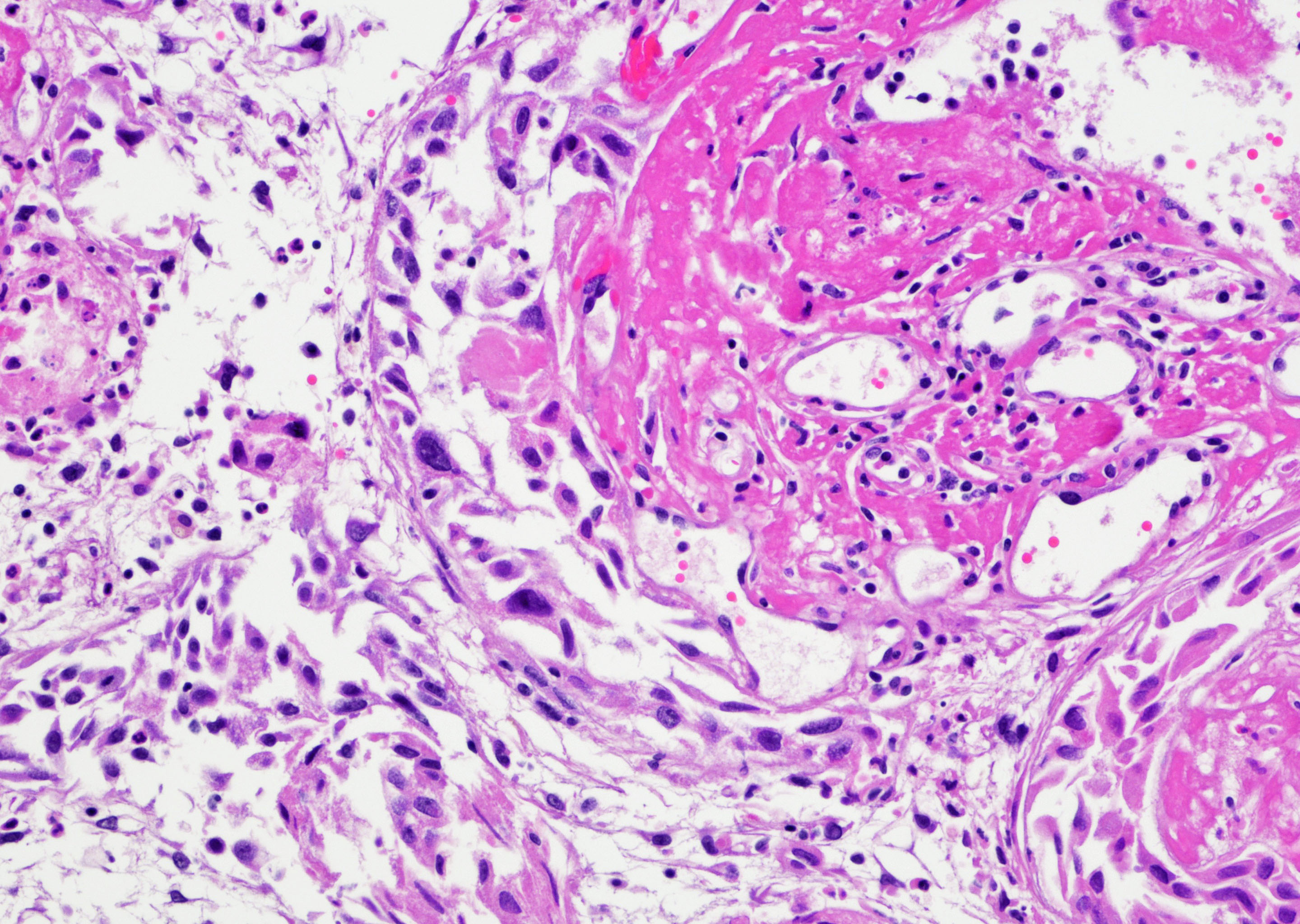 Atypical urothelial proliferation