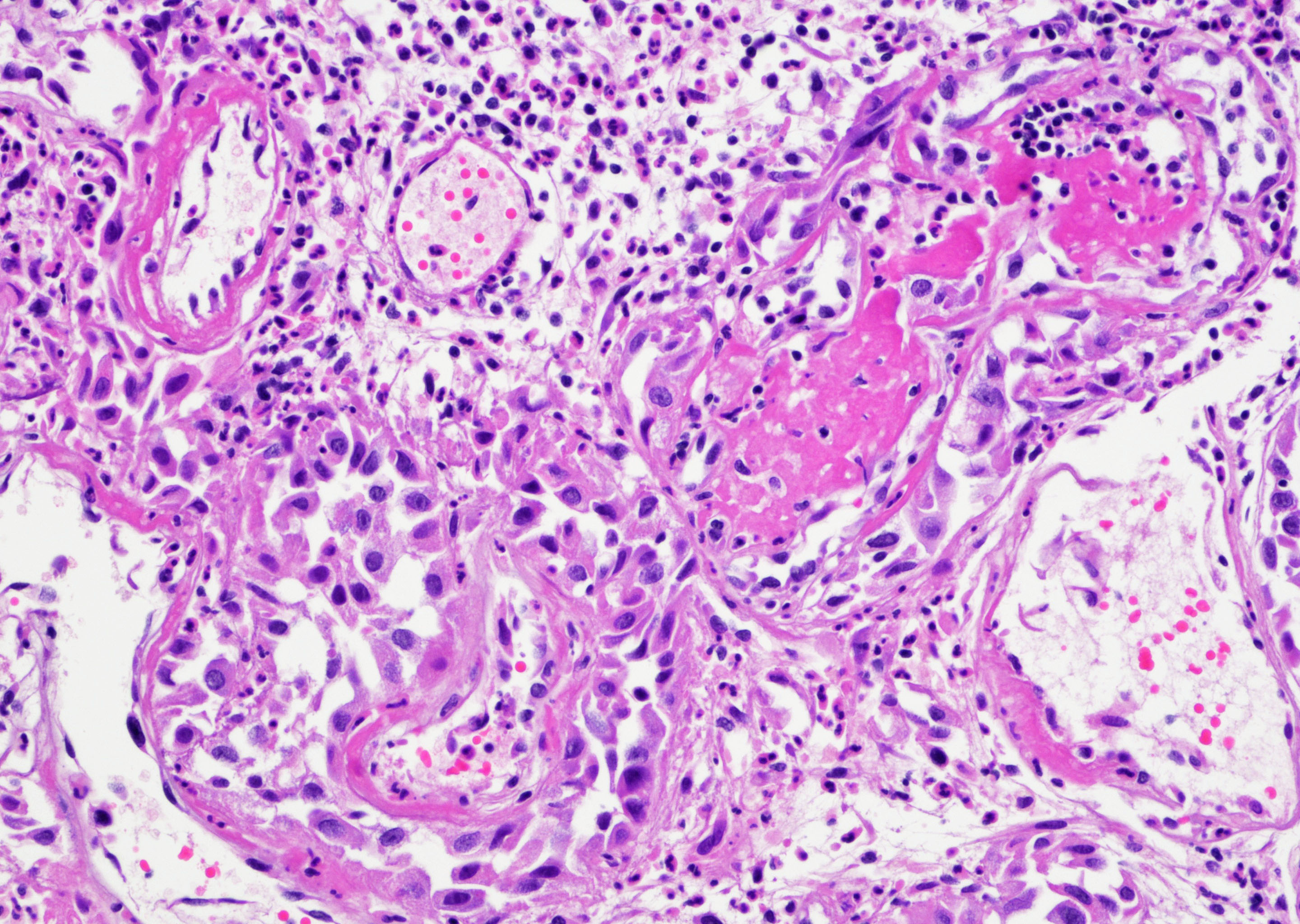 Atypical urothelial proliferation