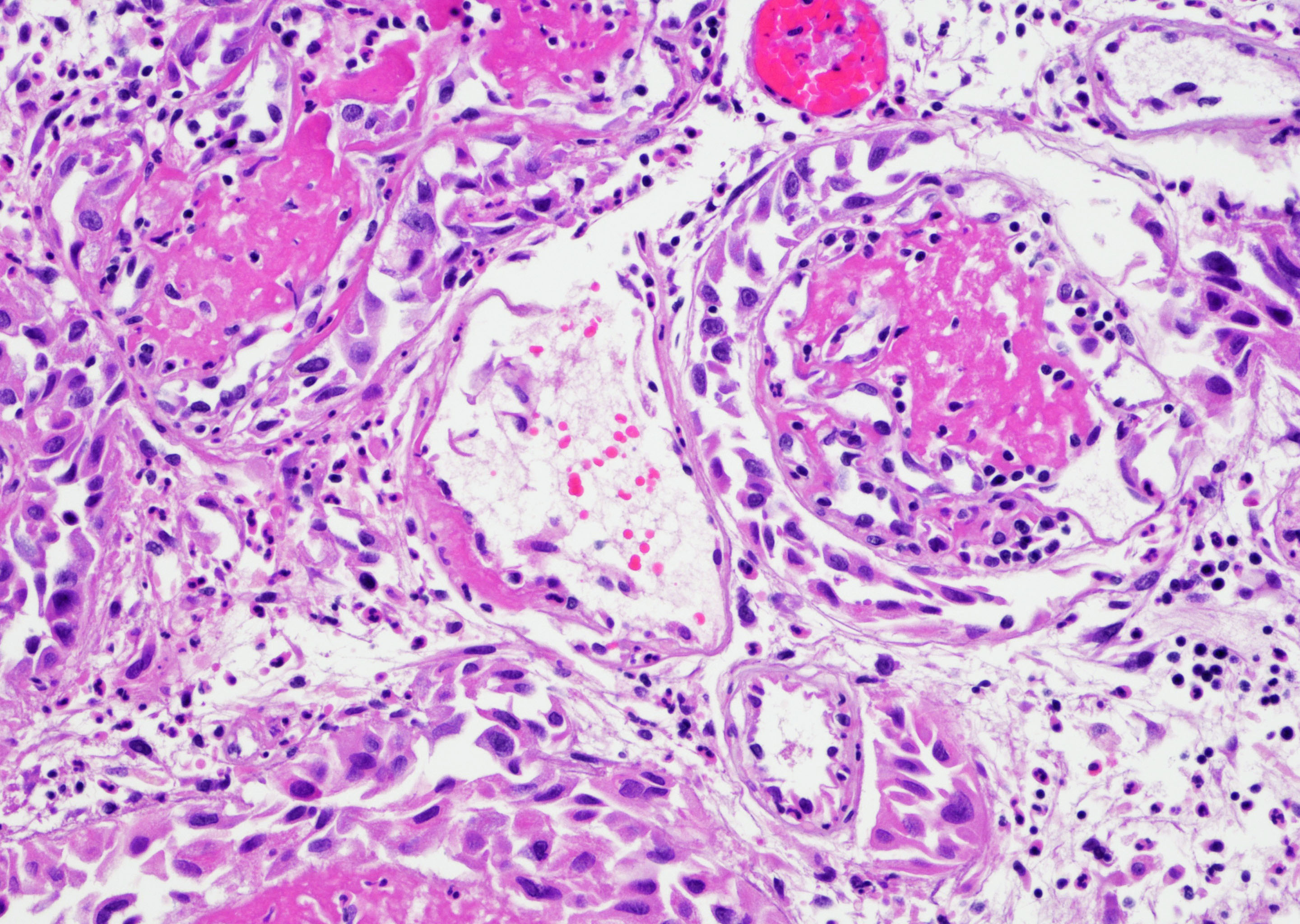 Fibrinoid vascular necrosis