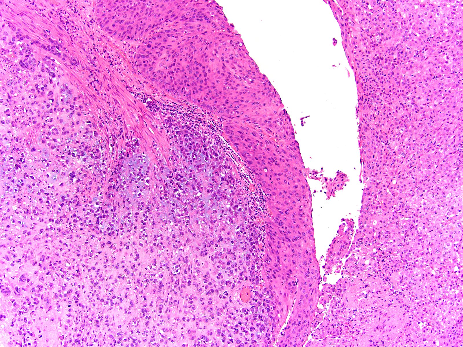 Classic urothelial carcinoma