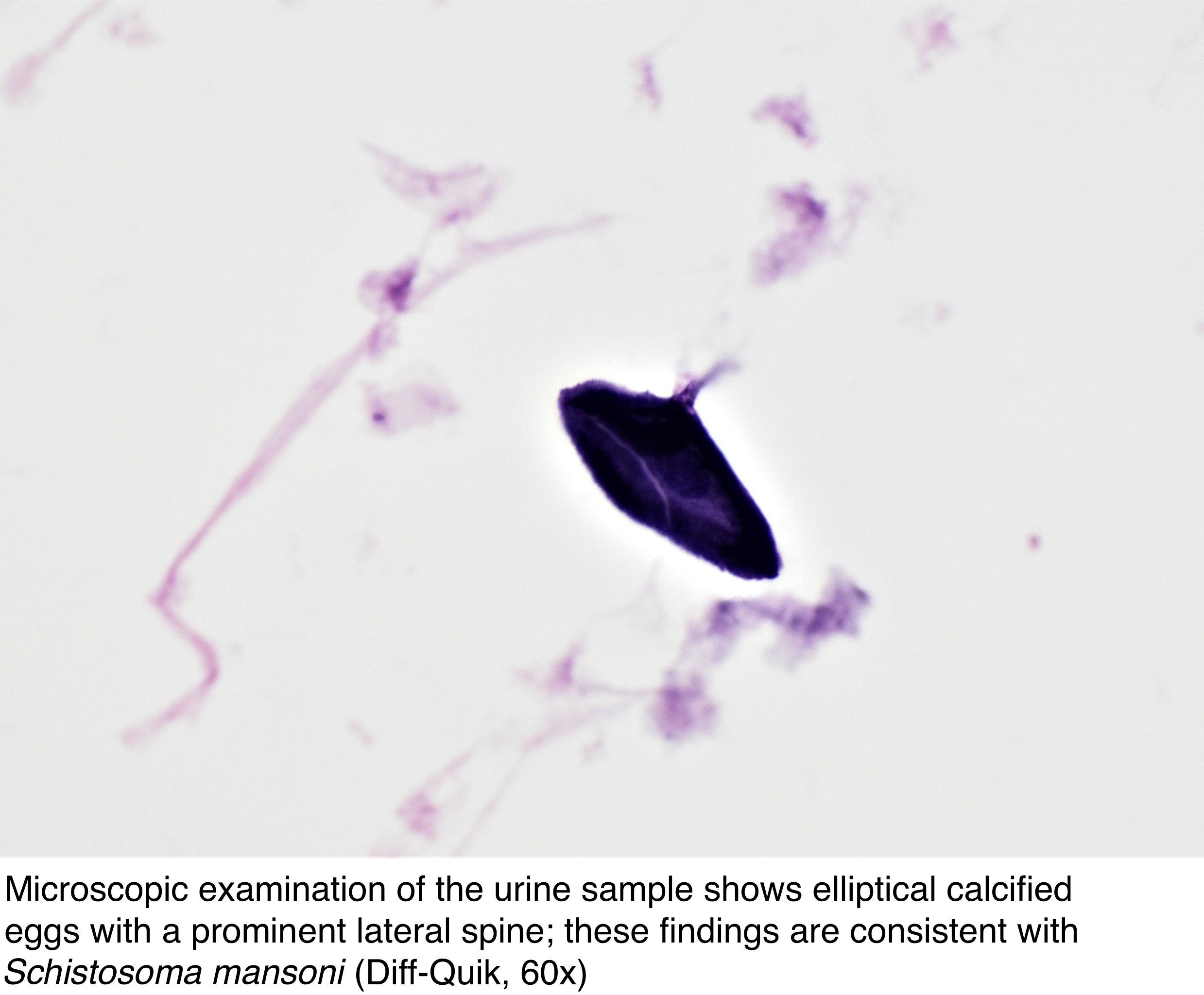 Schistosomiasis urine Schistosoma haematobium egg papiloma en laringe sintomas
