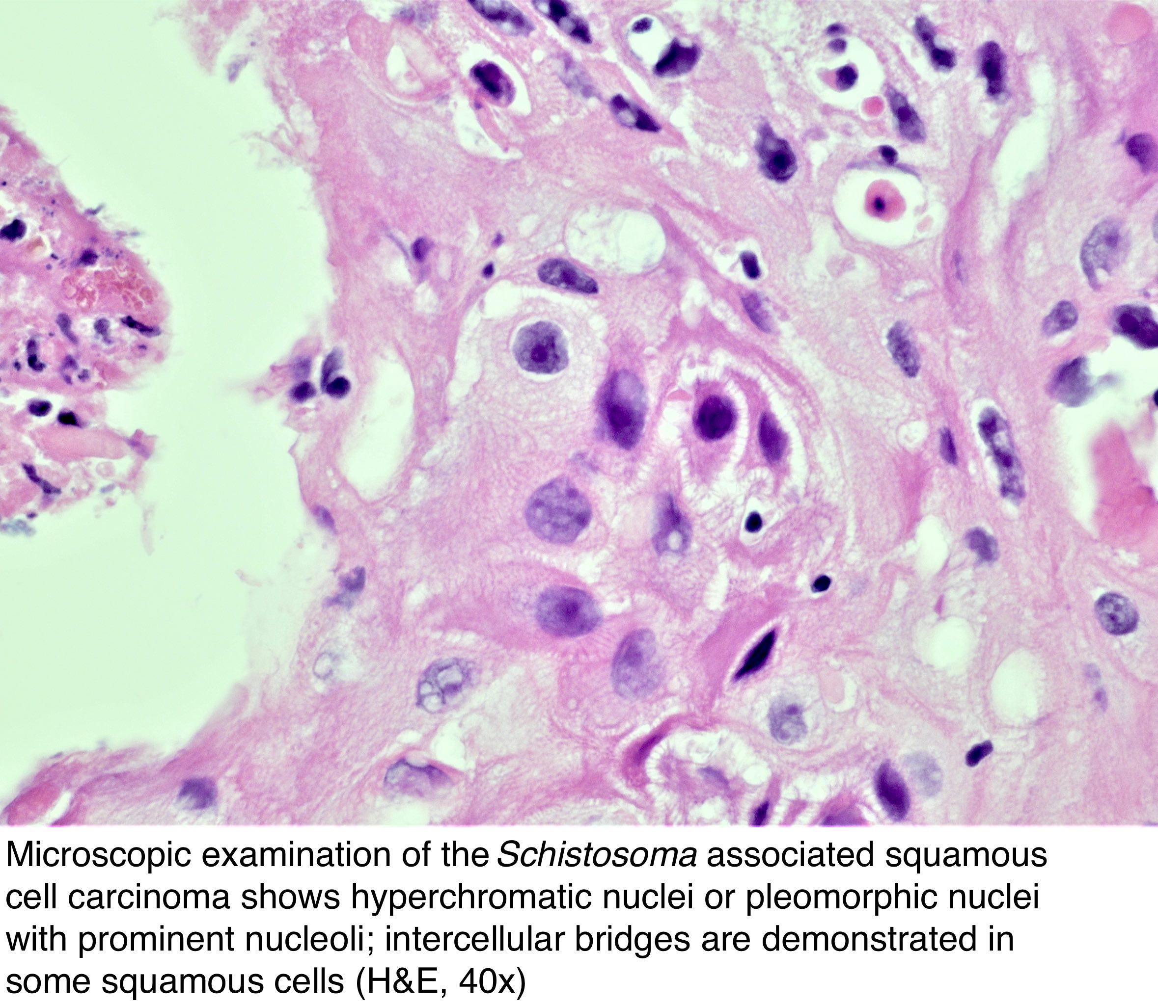 schistosomiasis and bladder cancer)