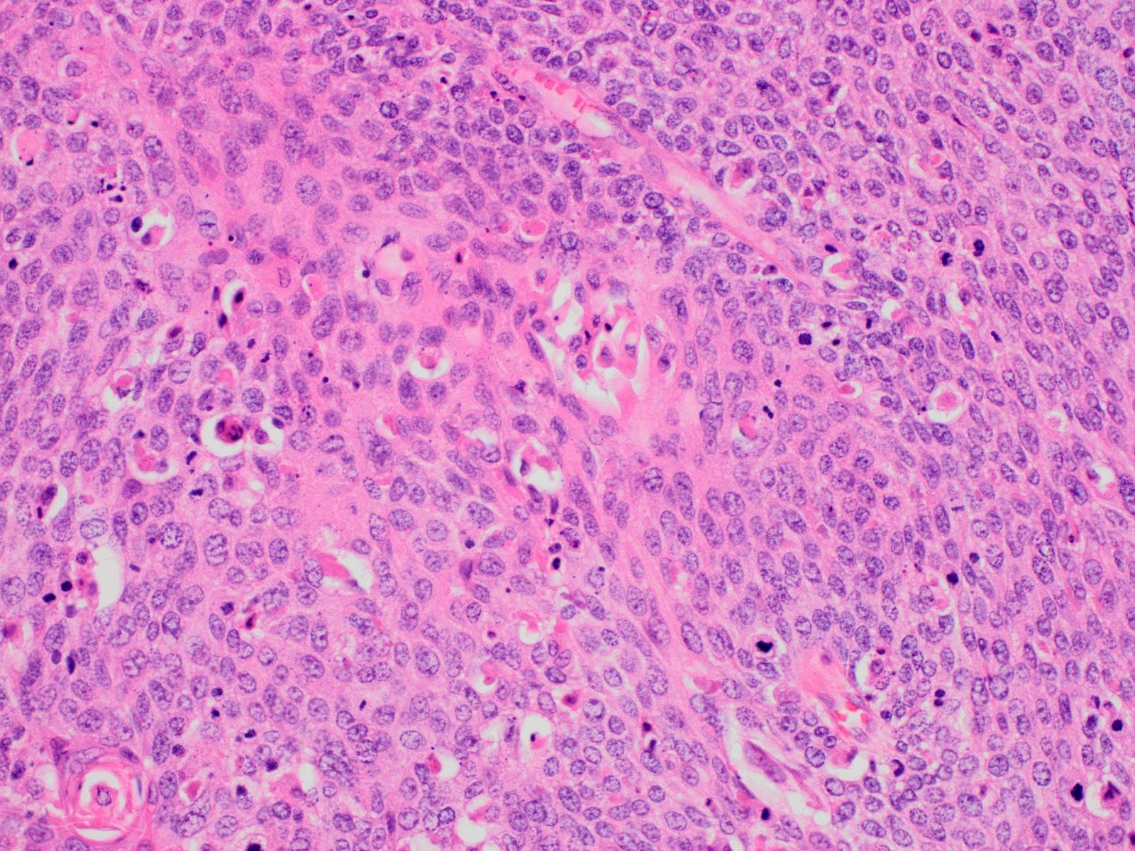 Poorly differentiated tumor