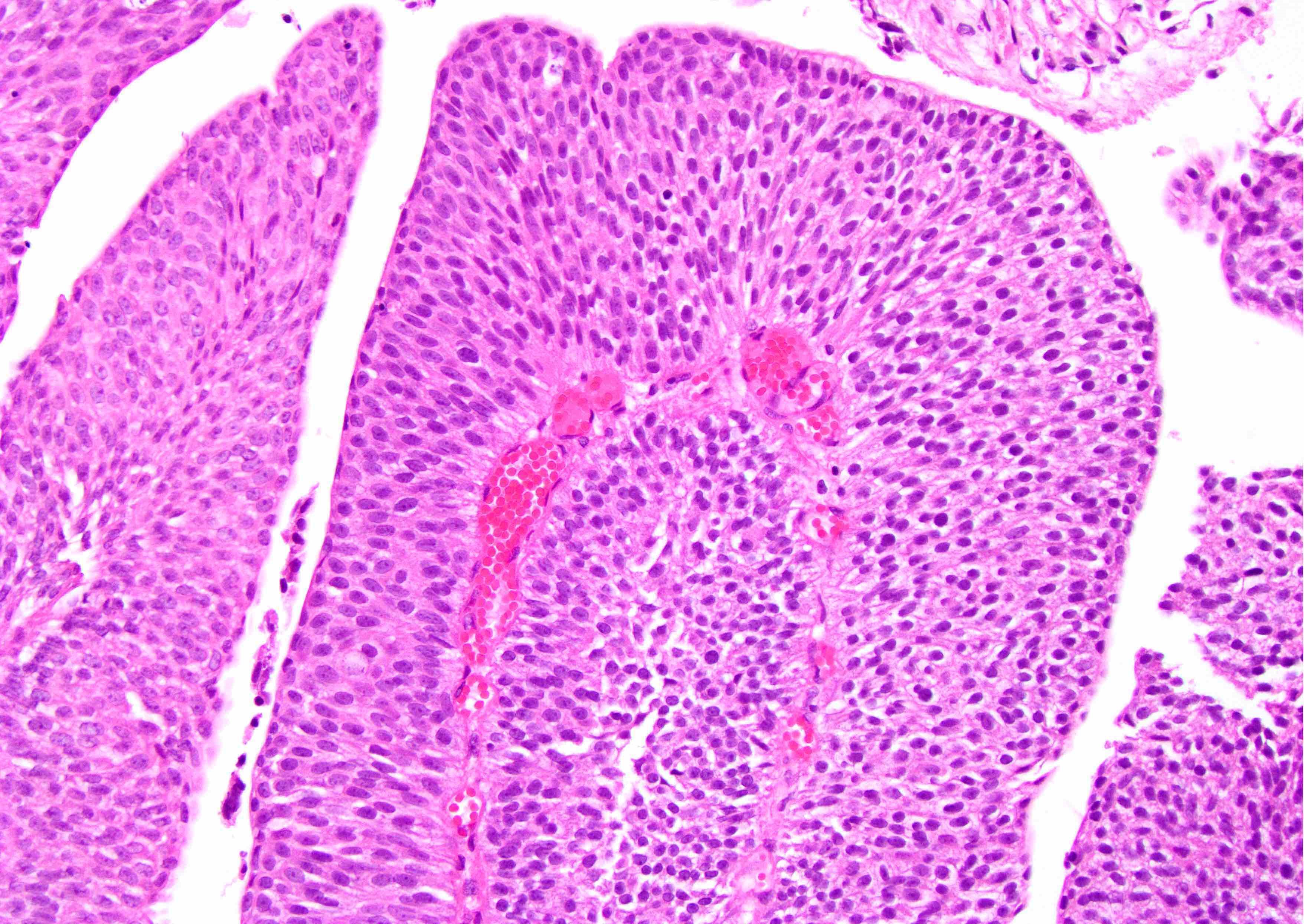 Papilloma urinary bladder pathology outlines Curs Engleza Partea 2 sos-tractaripitesti.ro