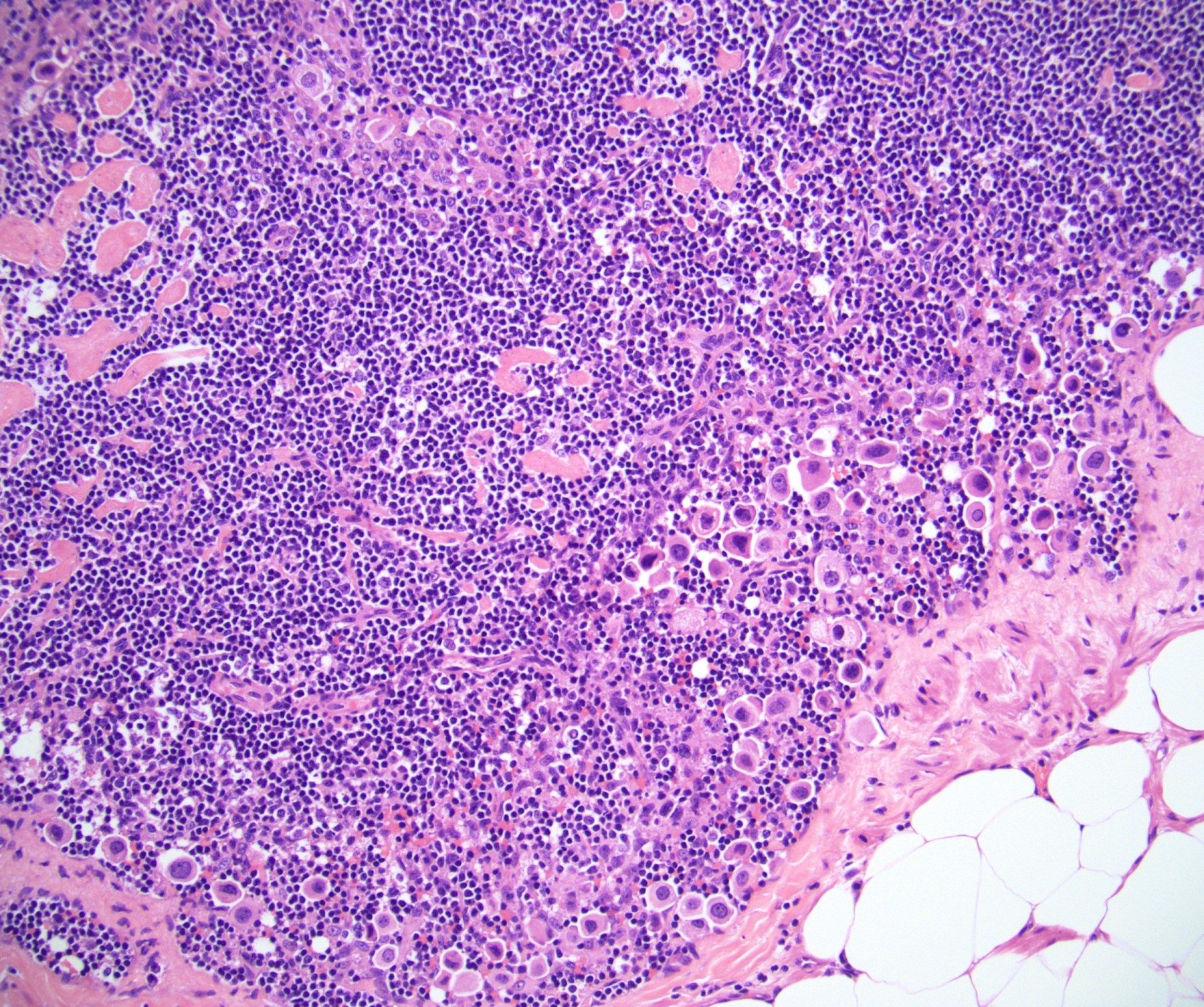Lymph node metastasis (pN3)