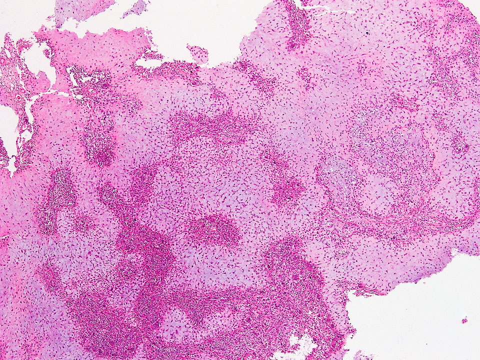 Confluent nodules with giant cells