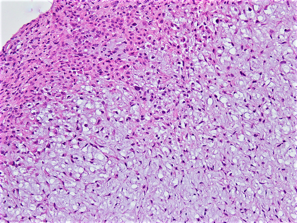 Peripheral giant cell proliferation