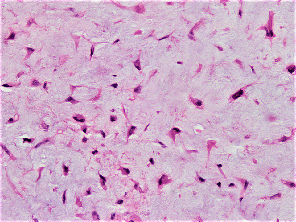 Stellate mesenchymal cells in nodules