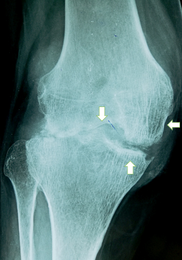 Left knee joint