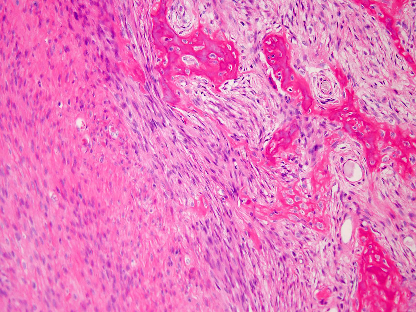 Pathology Outlines Low grade (central)