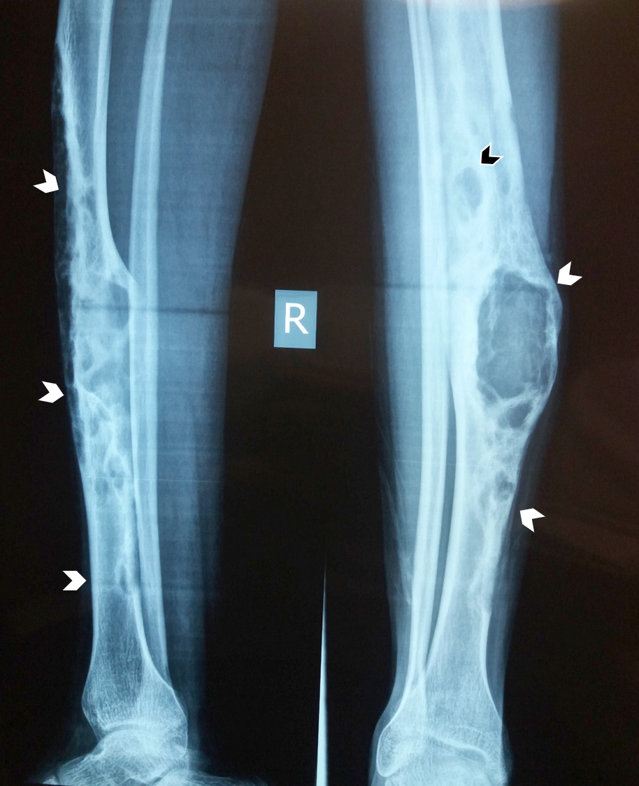 Multiloculated radiolucent lesion in tibia