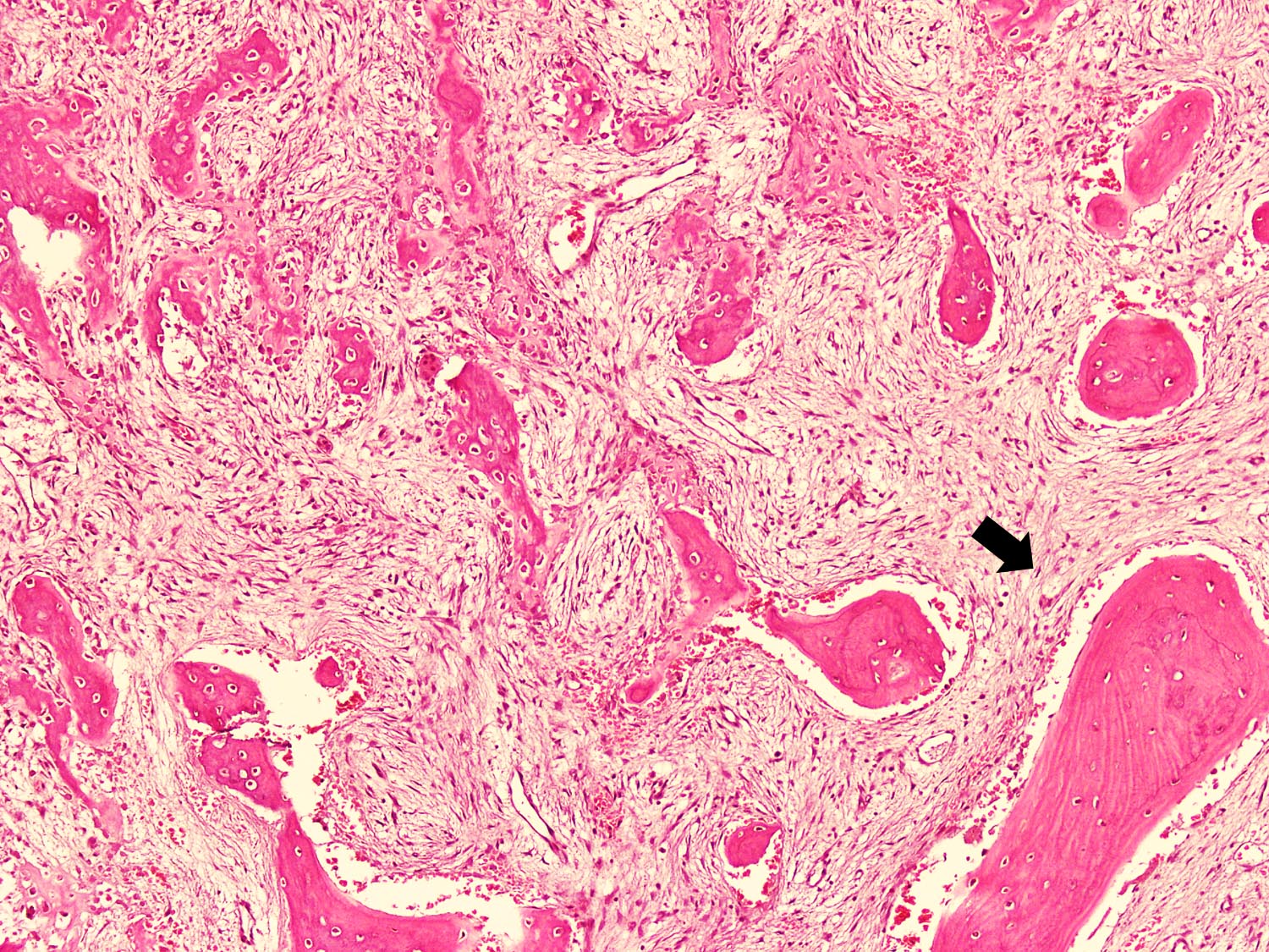 Fibro-osseous lesion with zonation pattern
