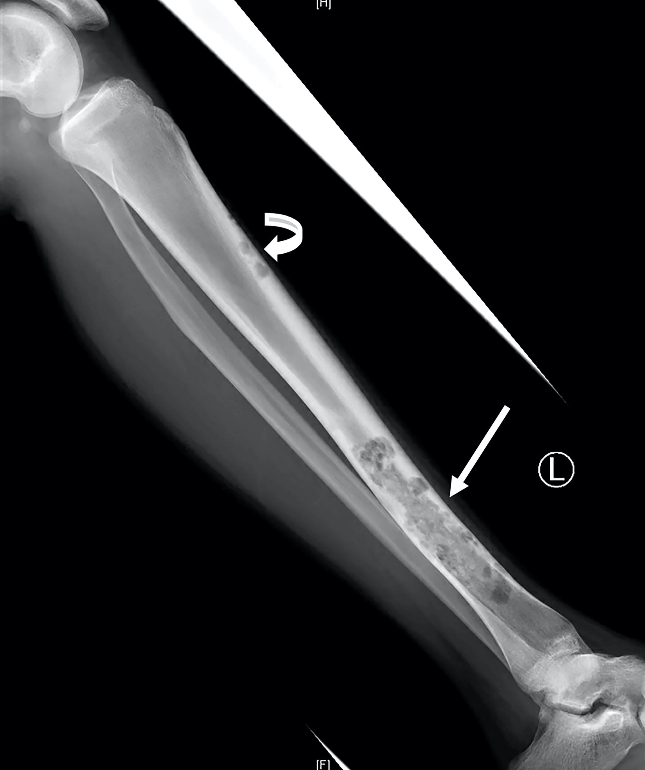 Tibia lesion, radiography