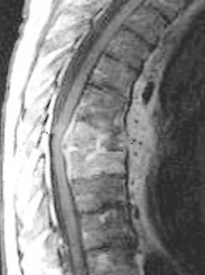 Bacterial osteomyelitis of tibia and vertebra in thoracic spine