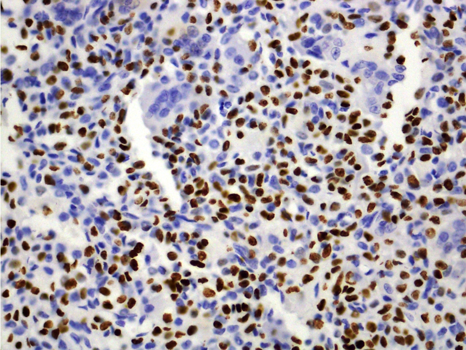 Chondroblastoma, H3K36M antibody