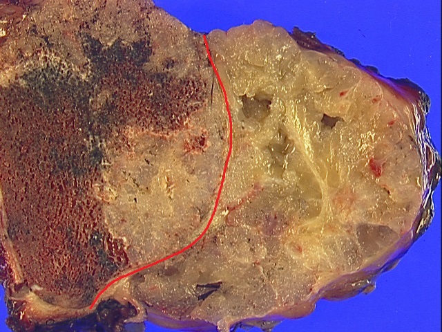 Pelvic tumor