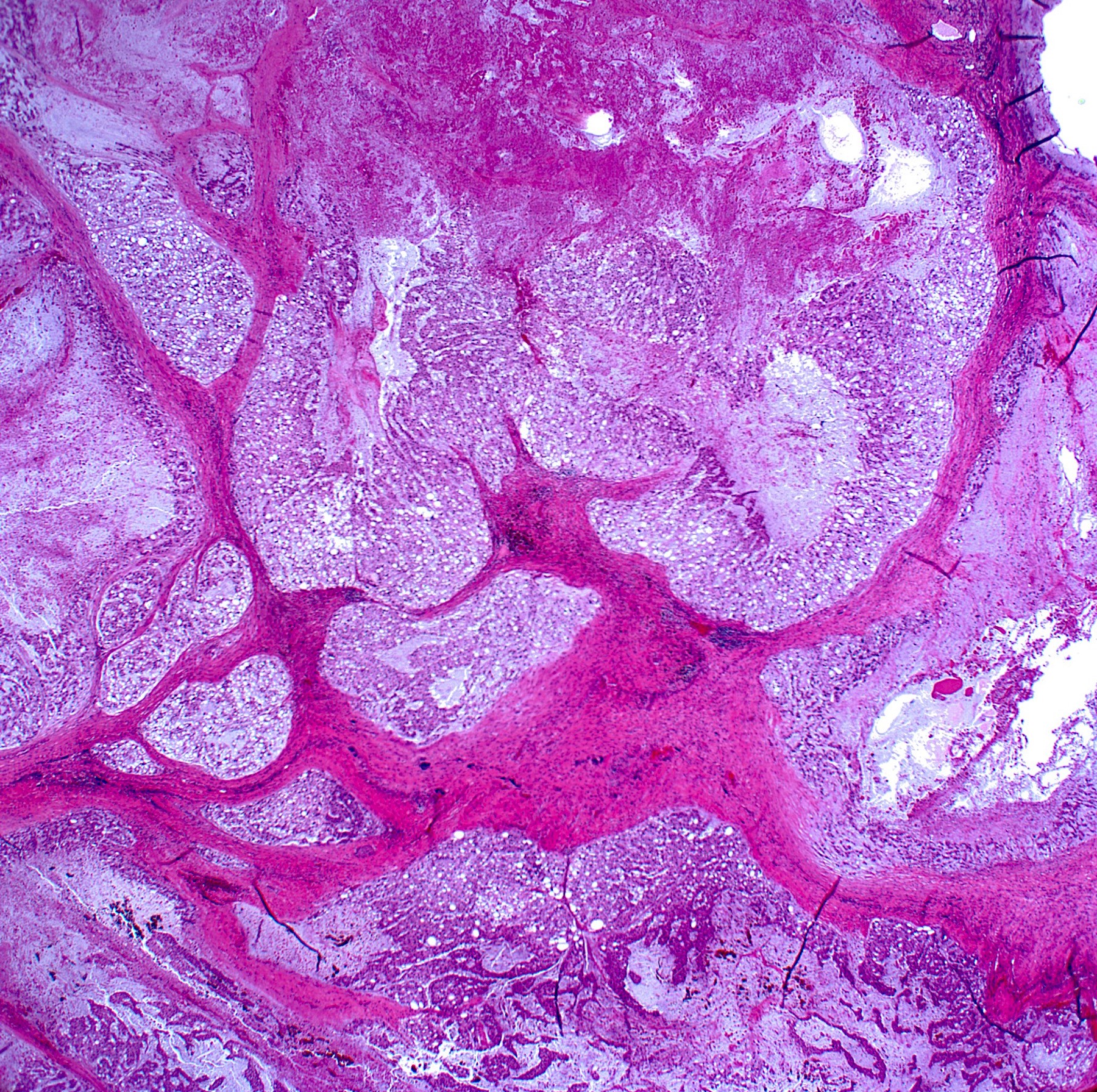 chondrosarcoma pathology outlines