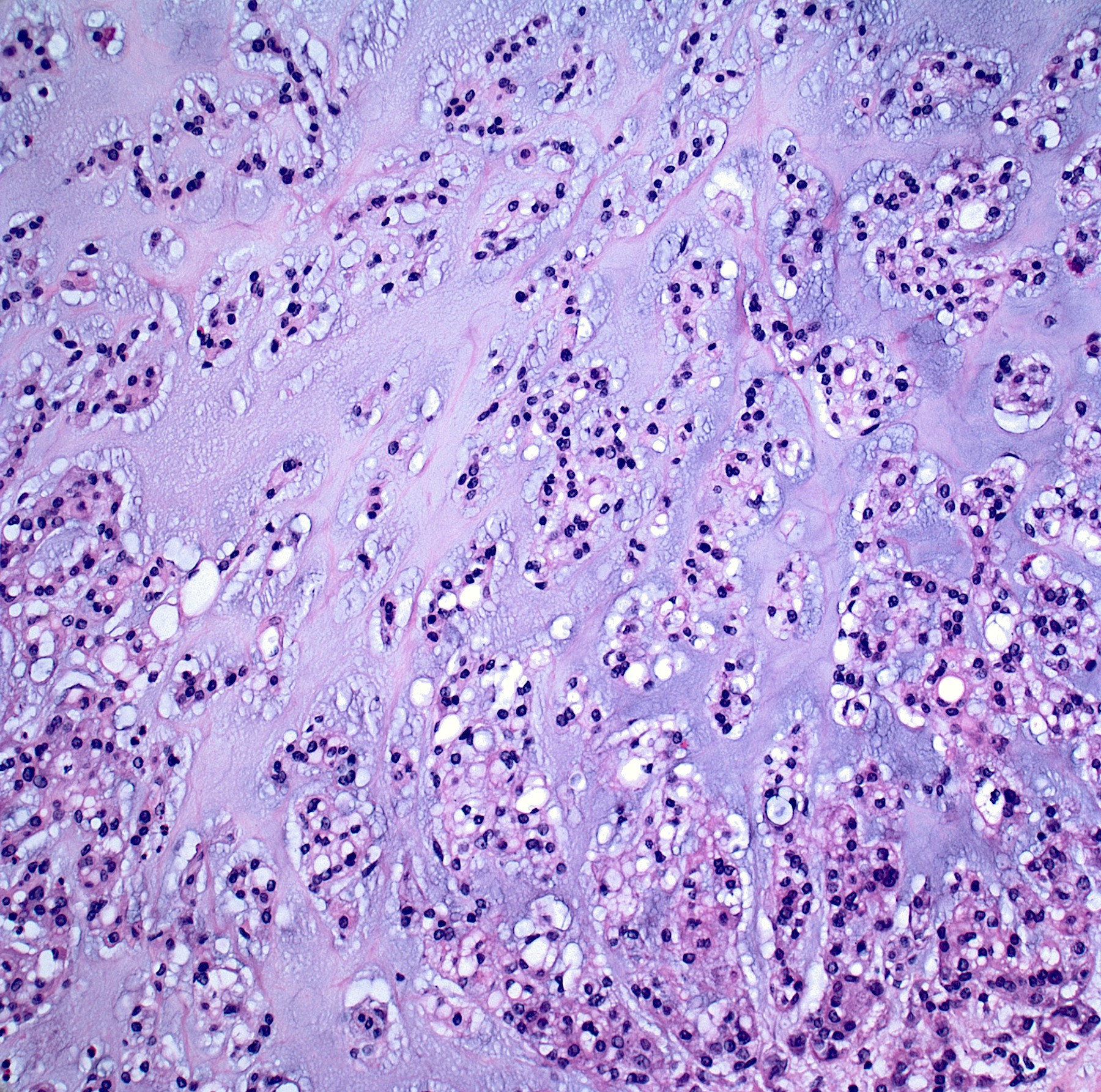 chondrosarcoma pathology outlines)