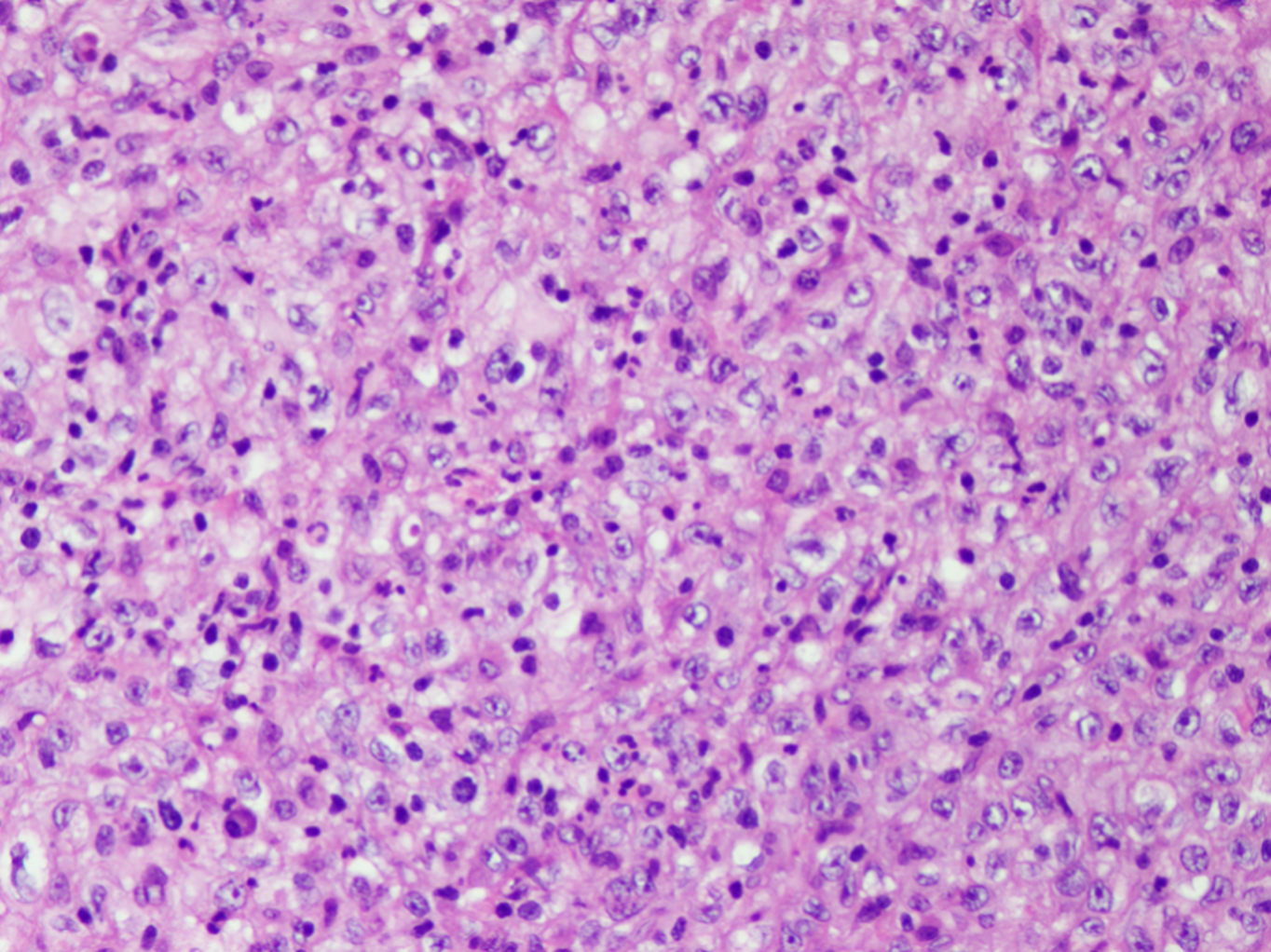 Poorly differentiated chordoma in 2 year old