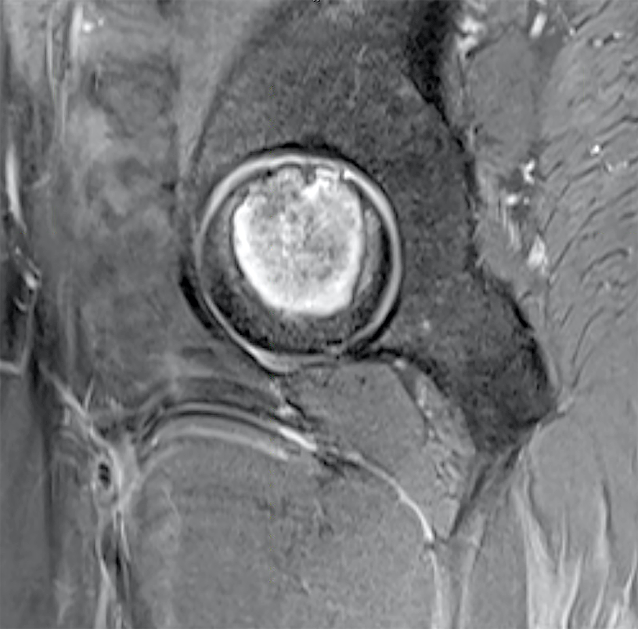T2 weighted MRI