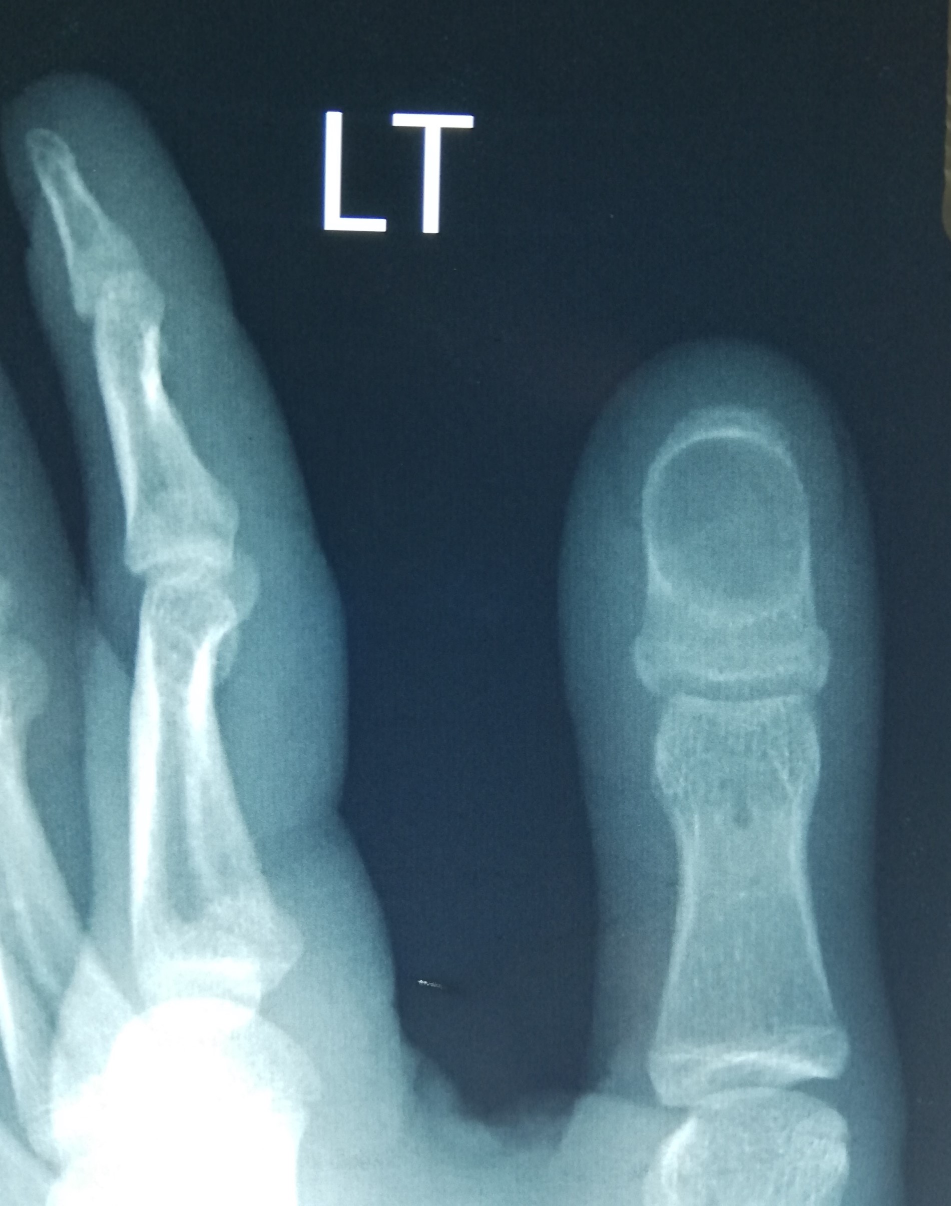 Distal phalanx of thumb