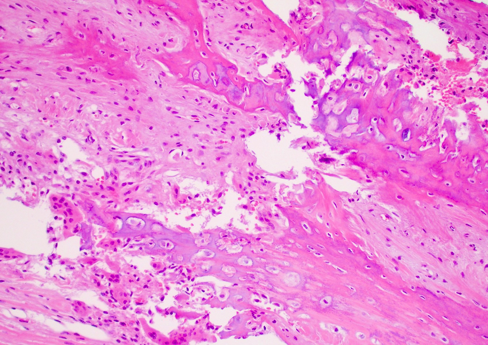 Pathology Outlines Fracture