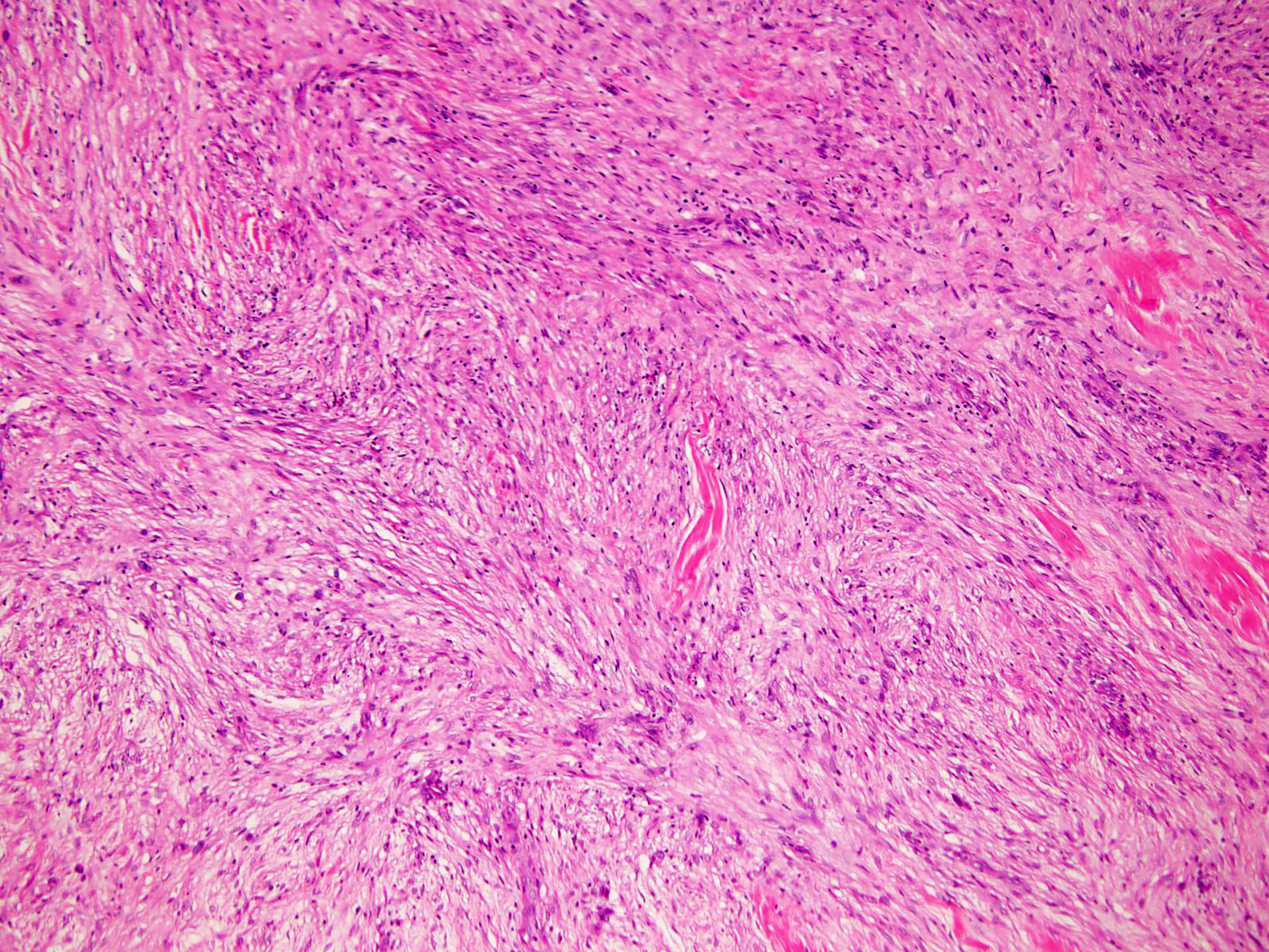 Spindle cell proliferation