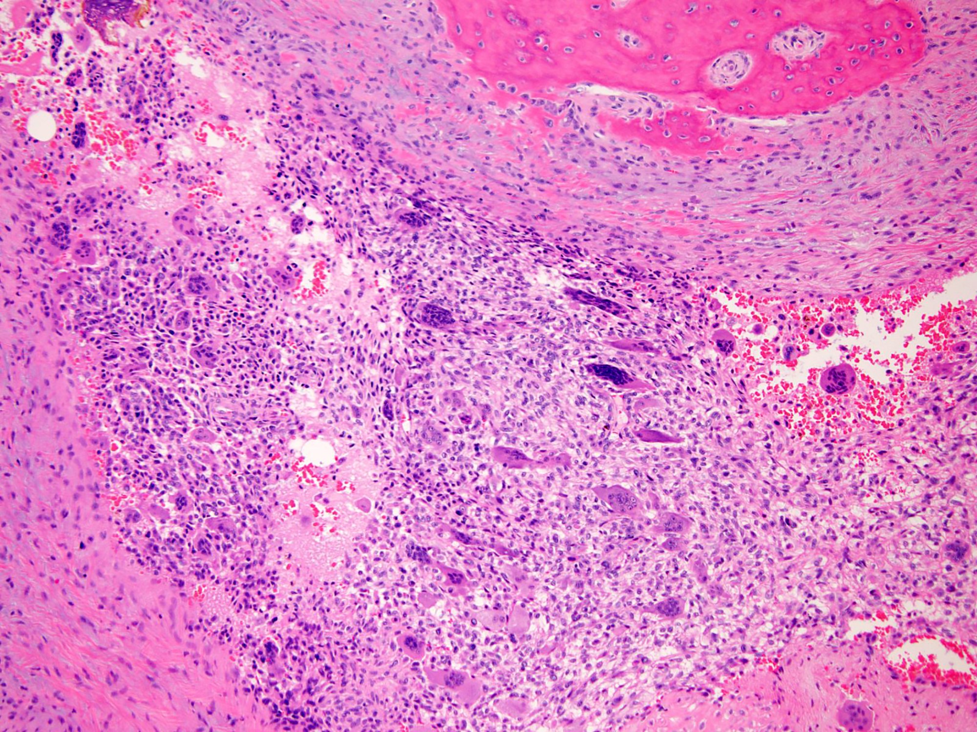 Giant cell tumor of bone 