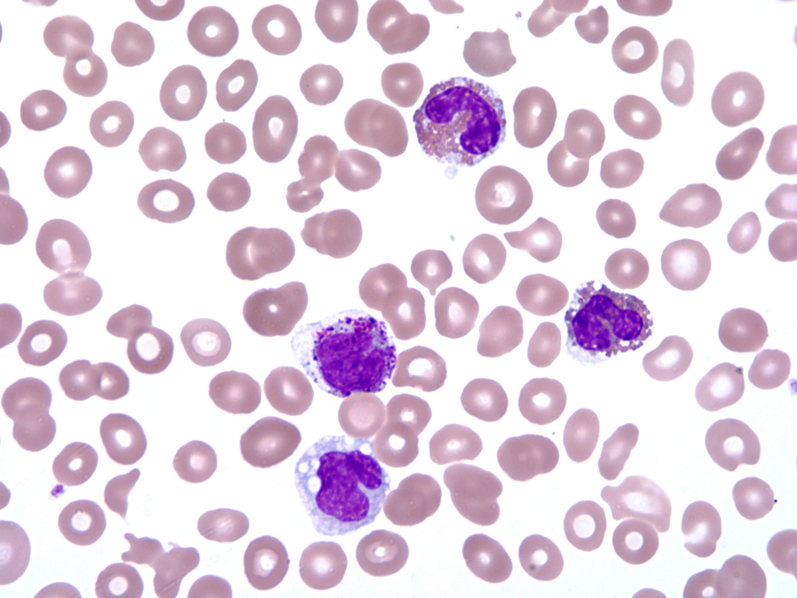 Increased eosinophils with abnormal granulation