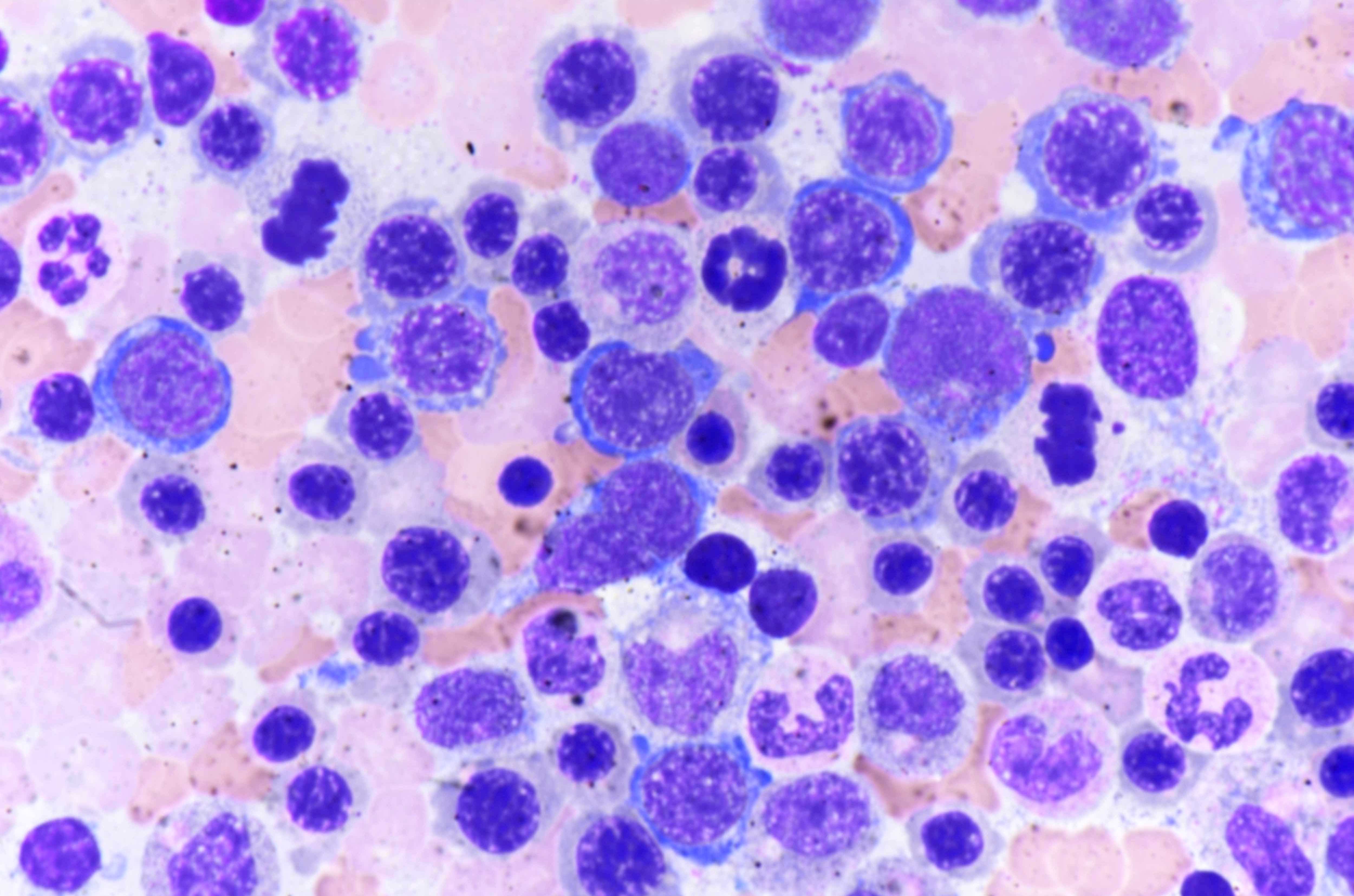 Frequent mitoses and neutrophil hypersegmentation